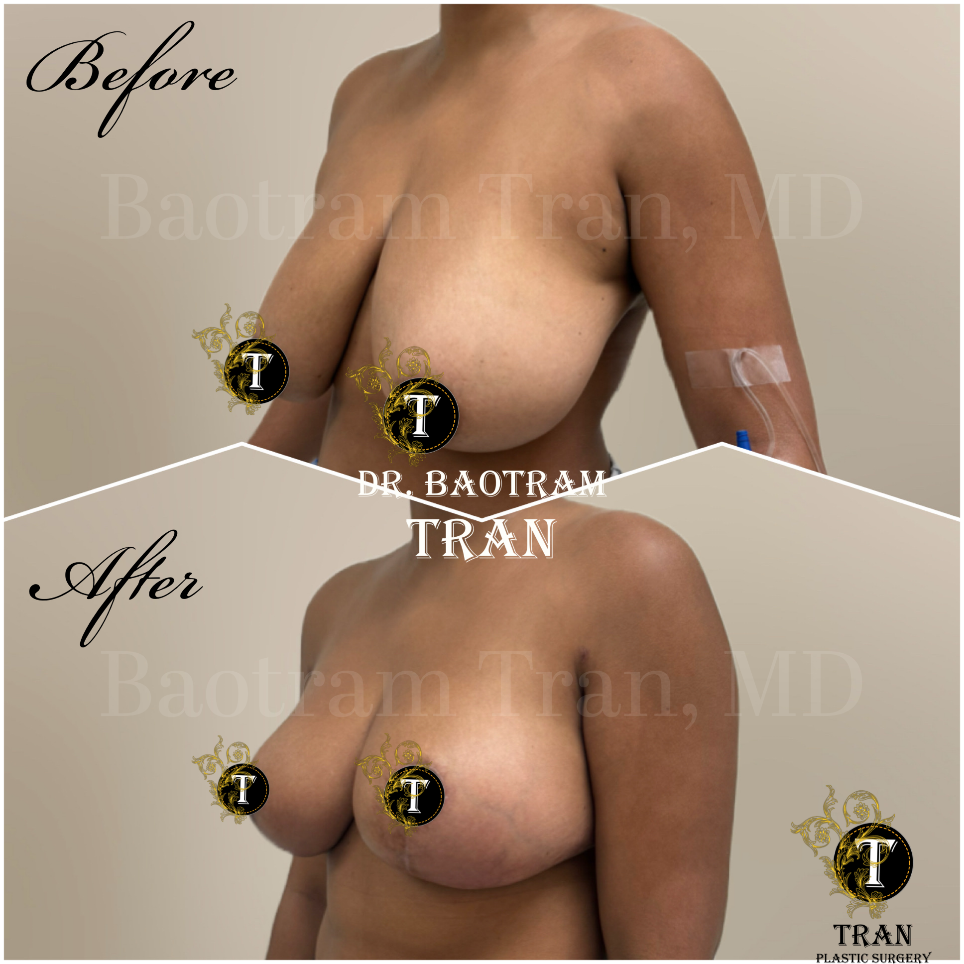 Before and After Image: Breast Reduction - left-front-oblique