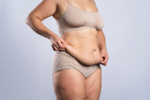 Woman pinches folds of loose skin before her tummy tuck