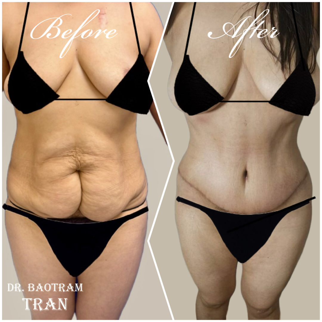 Before and After Image: Tummy Tuck