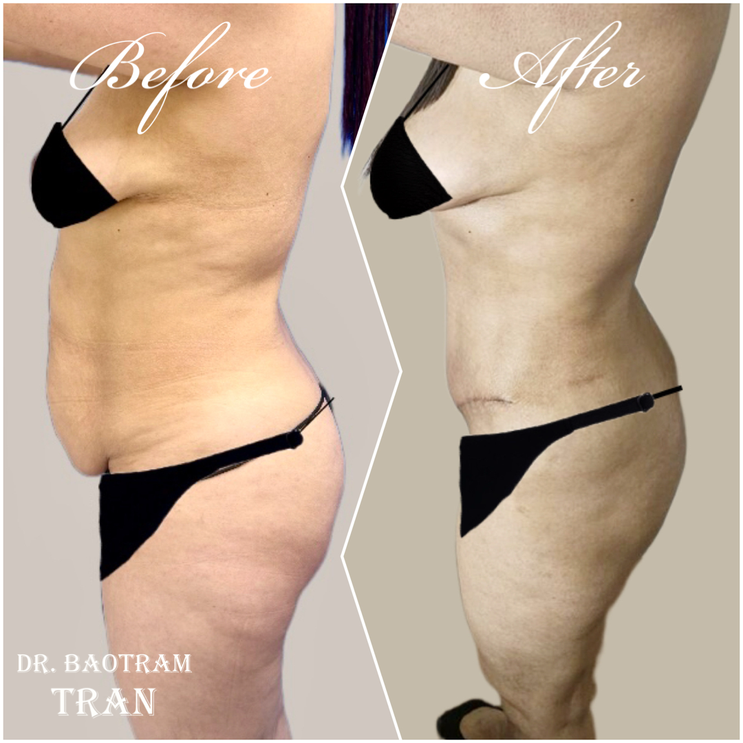 Before and After Image: Tummy Tuck - left-side