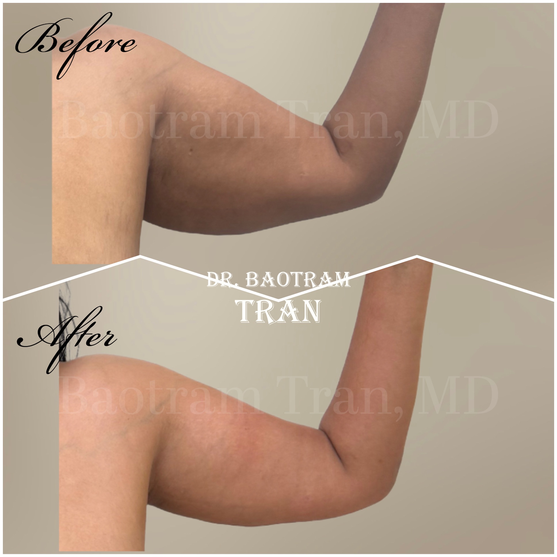 Before and After Image: Arm Lift
