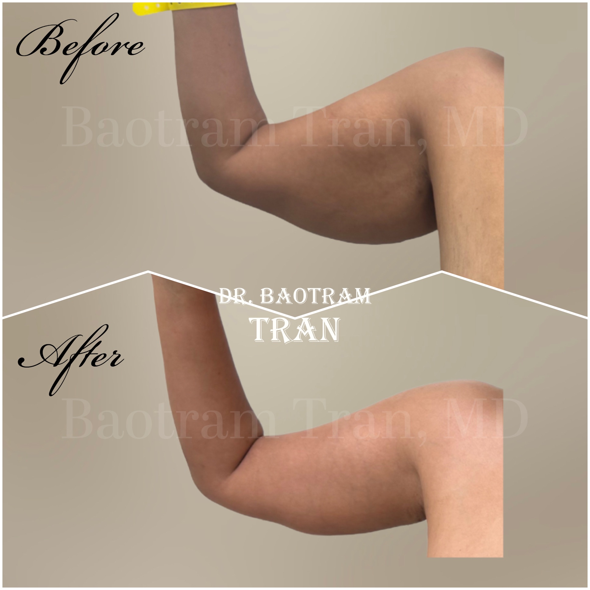 Before and After Image: Arm Lift - front