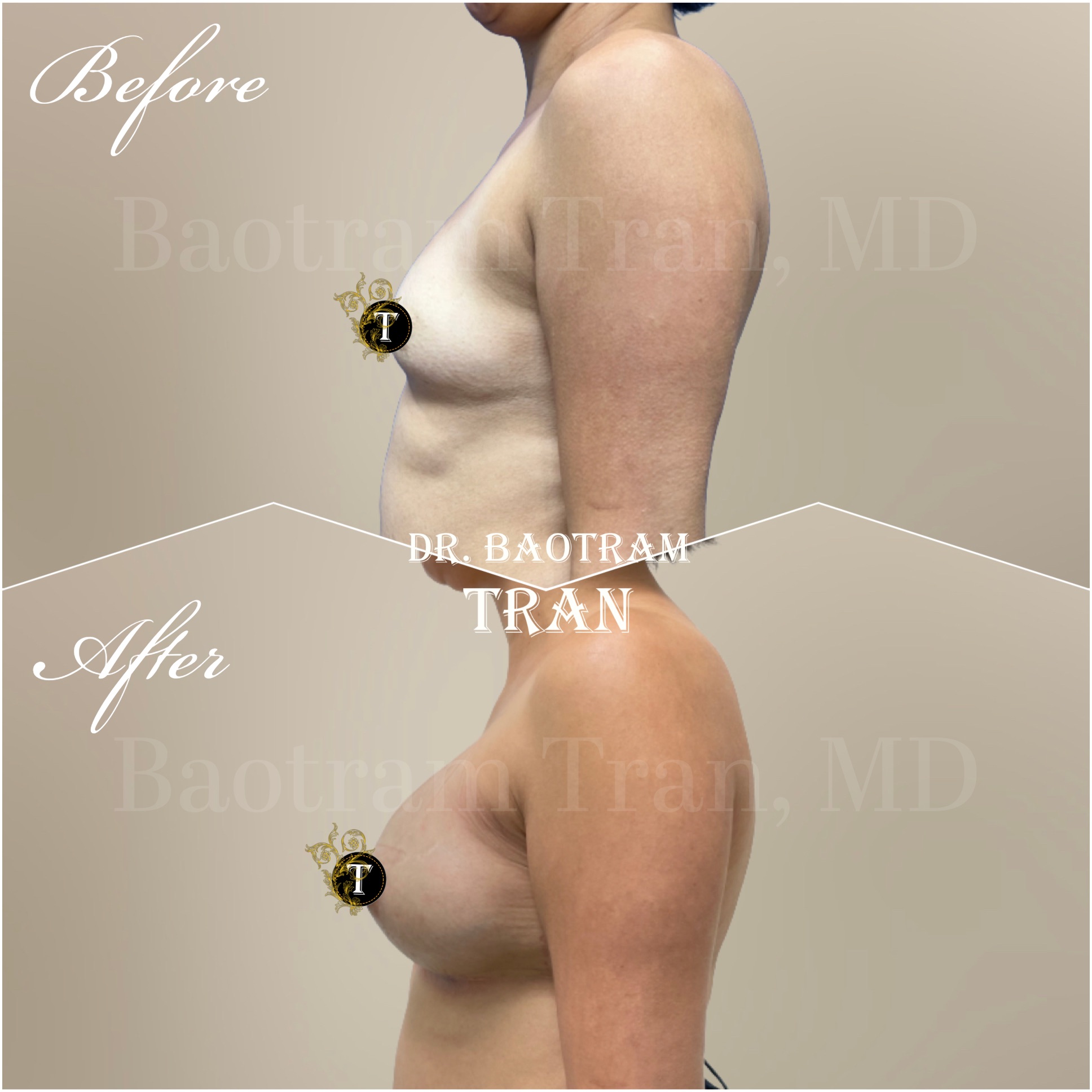 Before and After Image: Breast Augmentation - left-side