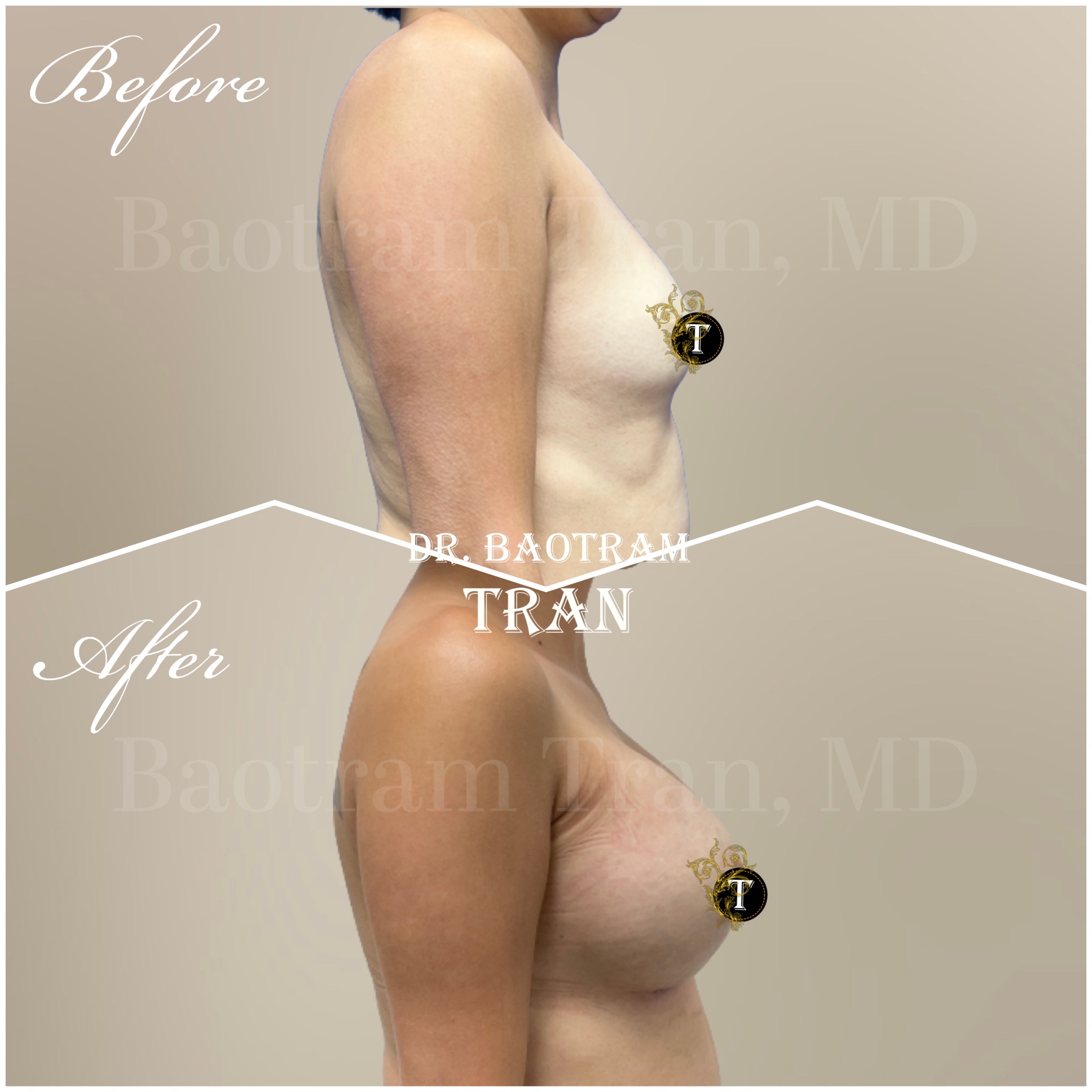 Before and After Image: Breast Augmentation - right-side