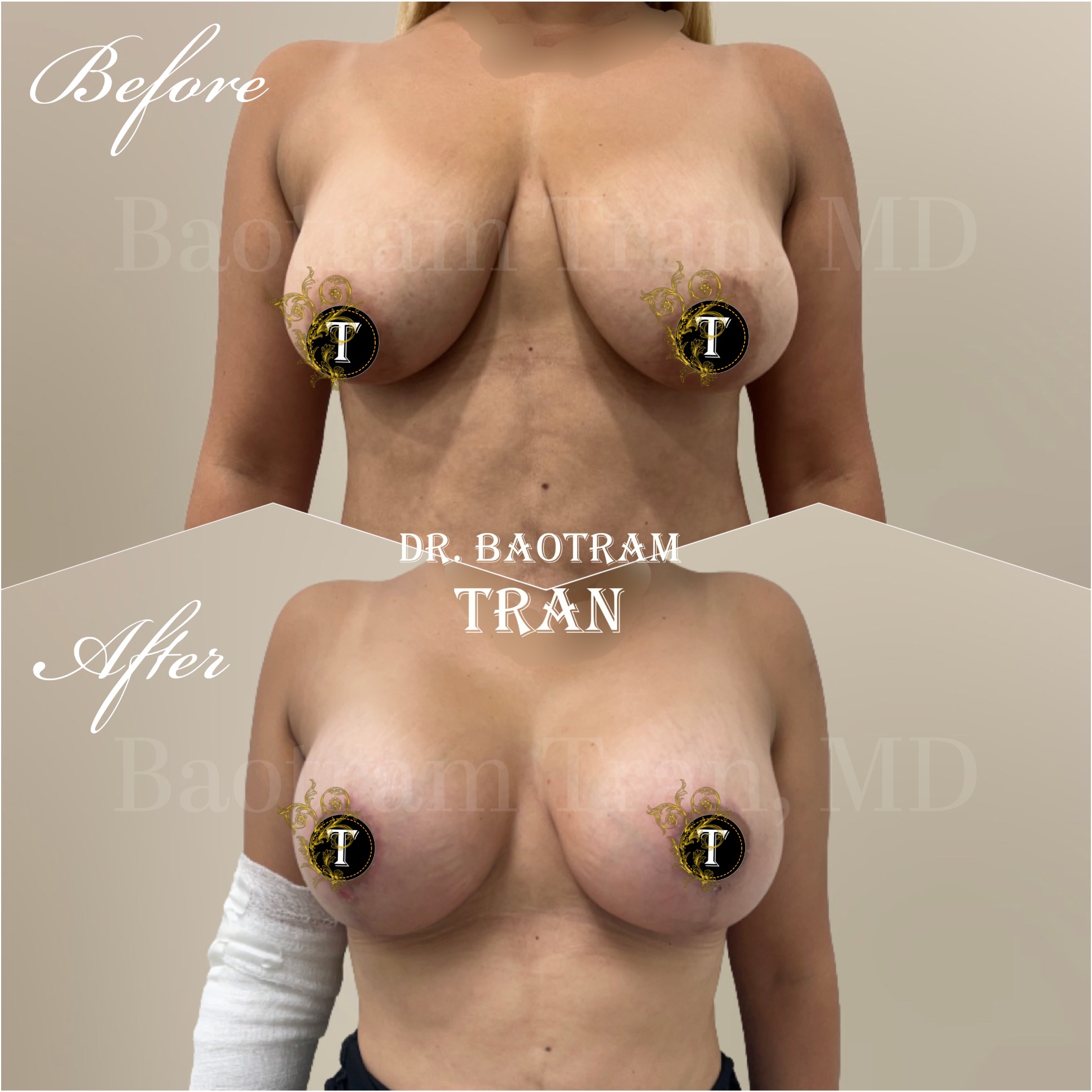 Before and After Image: Breast lift with implant