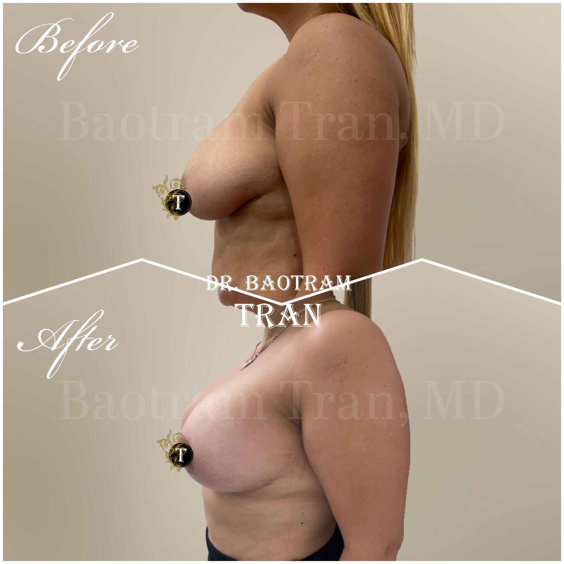 Before and After Image: Breast lift with implant - left-side