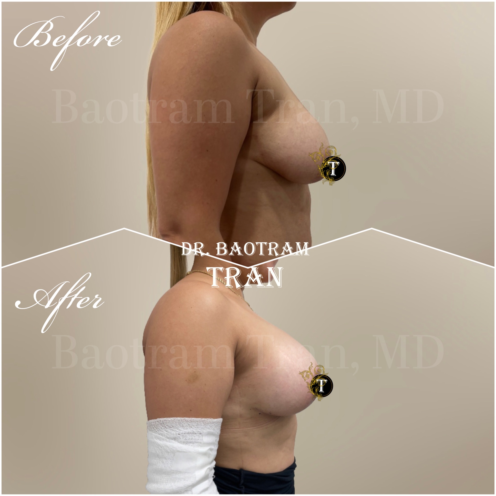 Before and After Image: Breast lift with implant - right-side