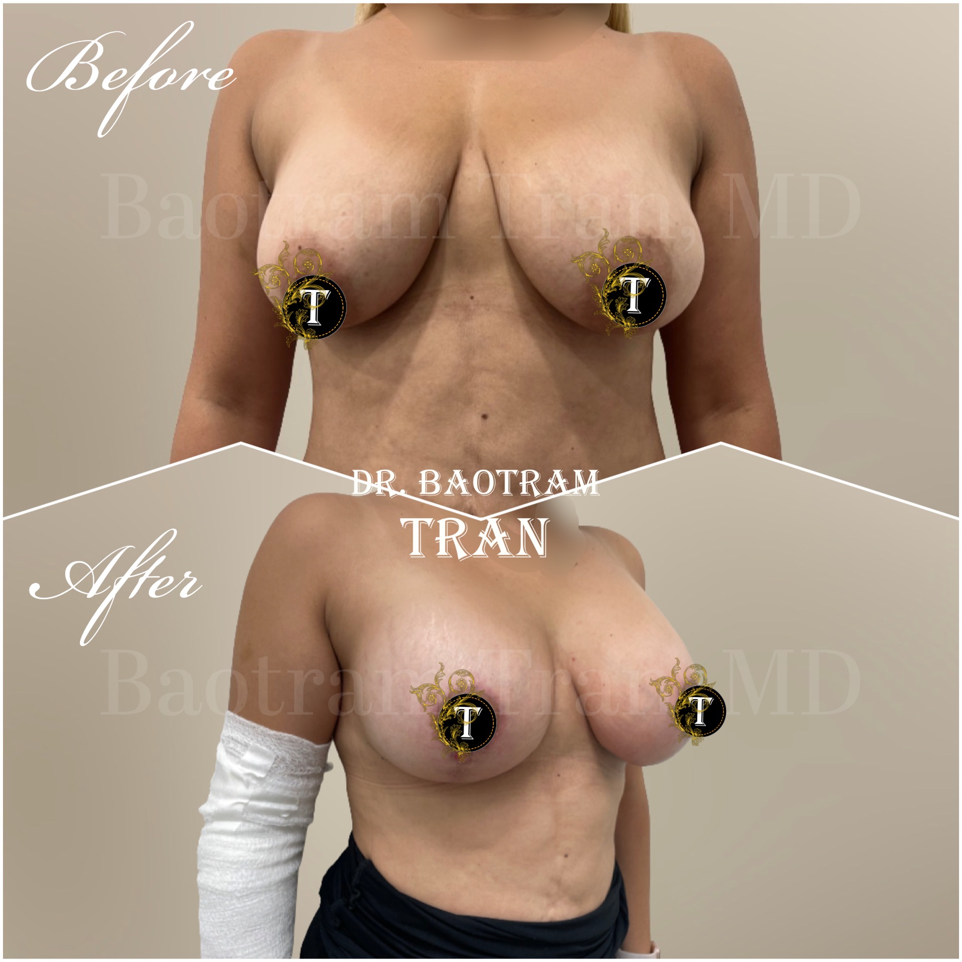 Before and After Image: Breast lift with implant - right-front-oblique
