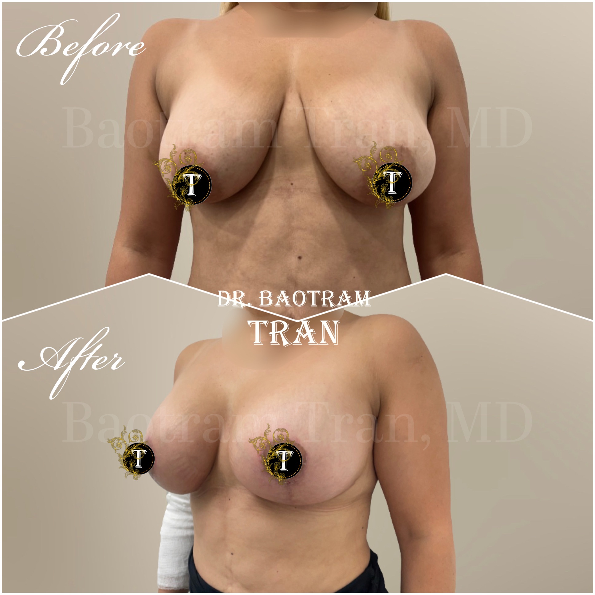 Before and After Image: Breast lift with implant - left-front-oblique