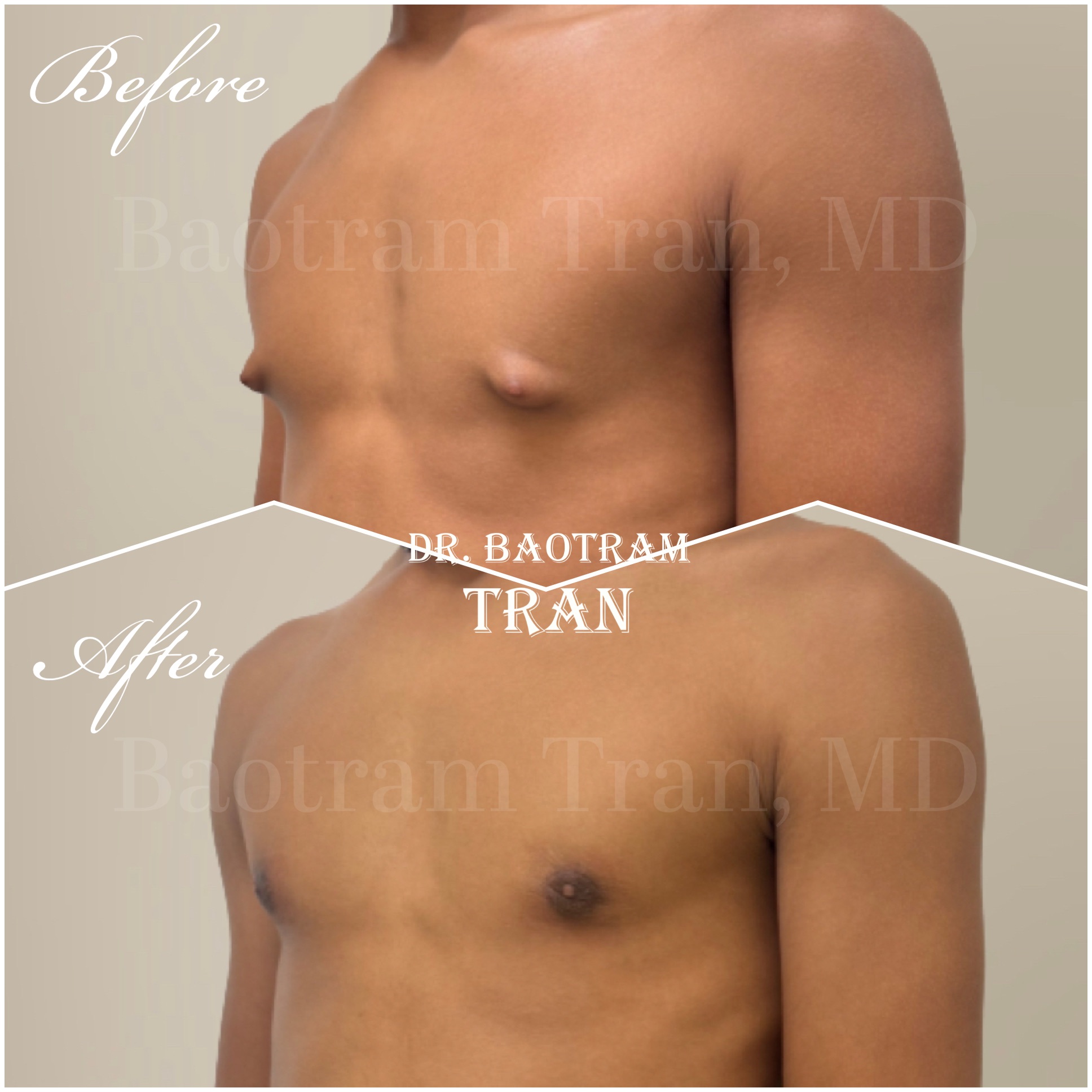 Before and After Image: Gynecomastia - left-front-oblique