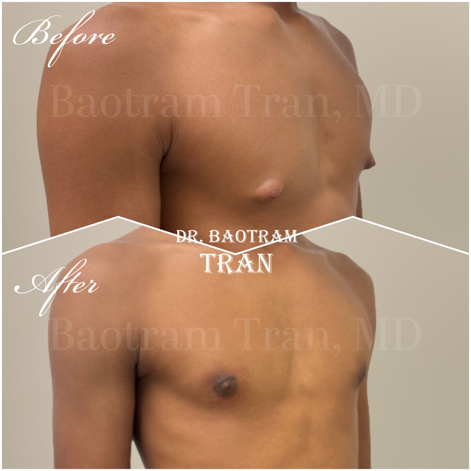 Before and After Image: Gynecomastia - right-front-oblique