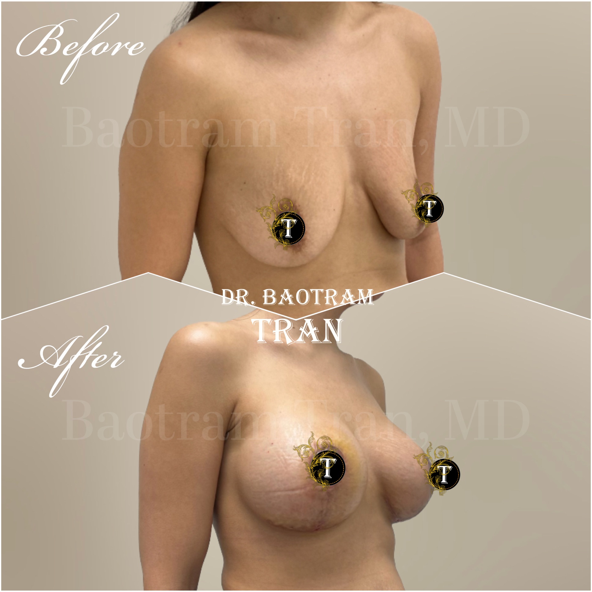 Before and After Image: Breast lift with implants - right-front-oblique