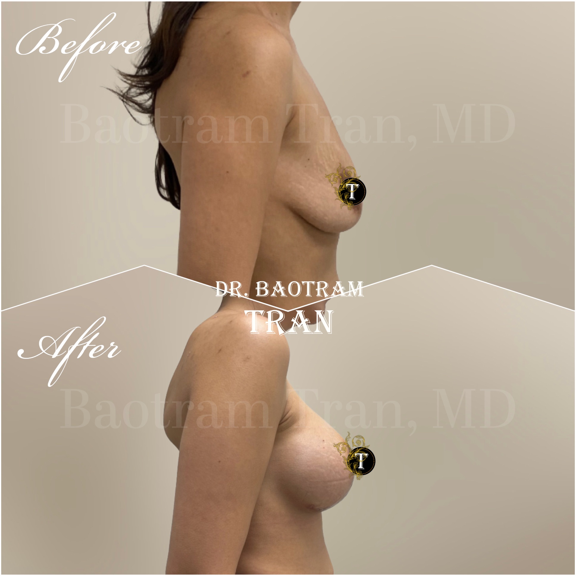 Before and After Image: Breast lift with implants - right-side