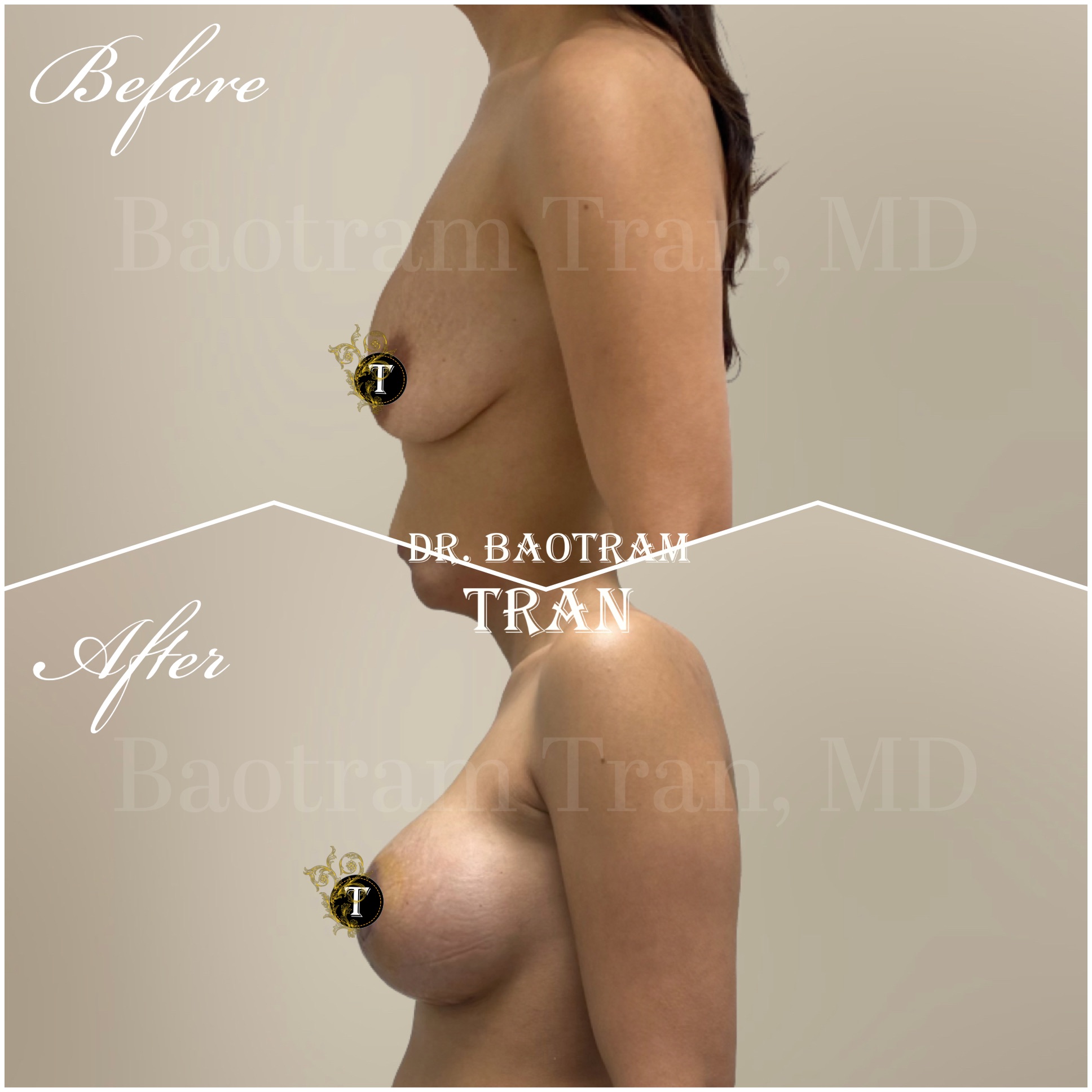 Before and After Image: Breast lift with implants - left-side