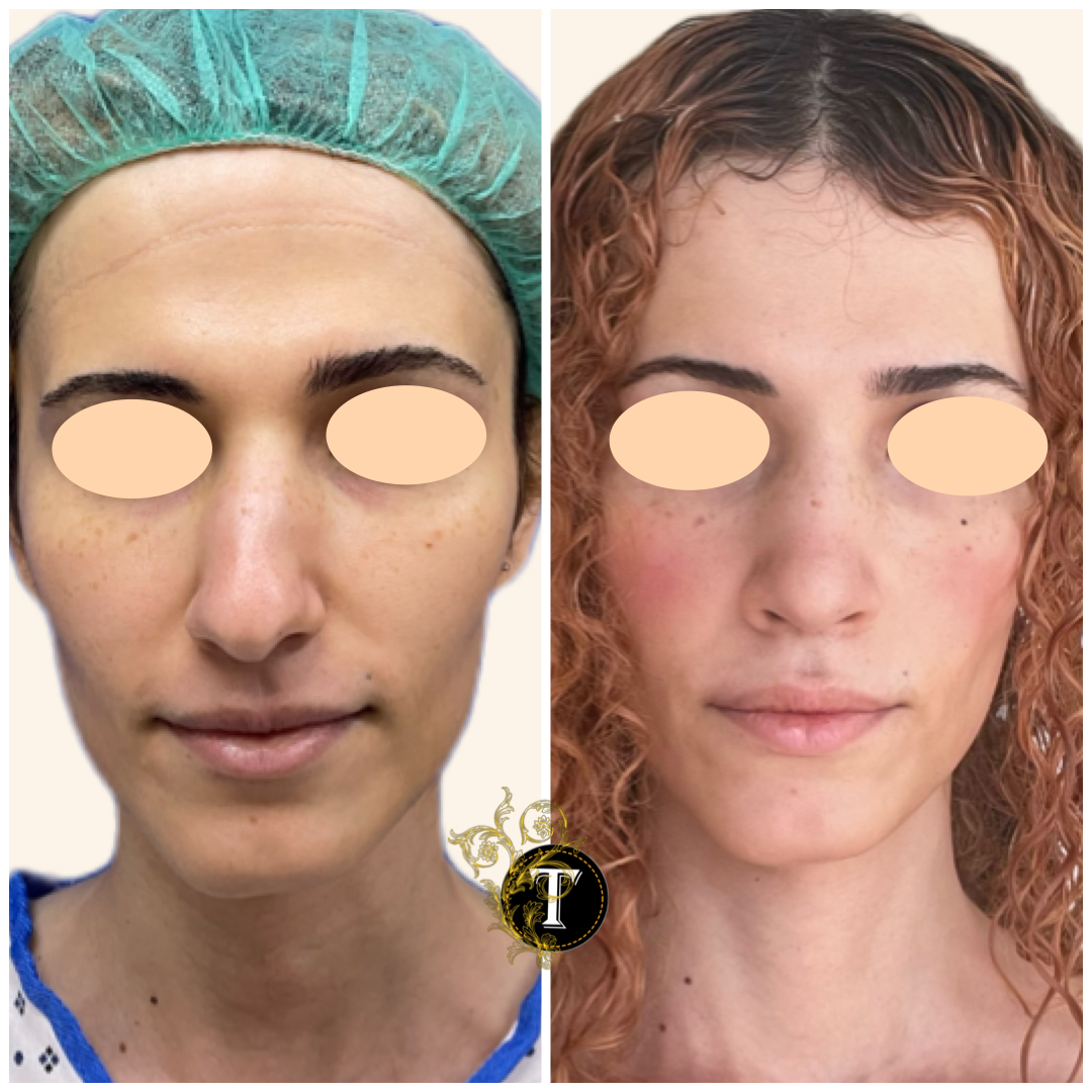 Before and After Image: Rhinoplasty