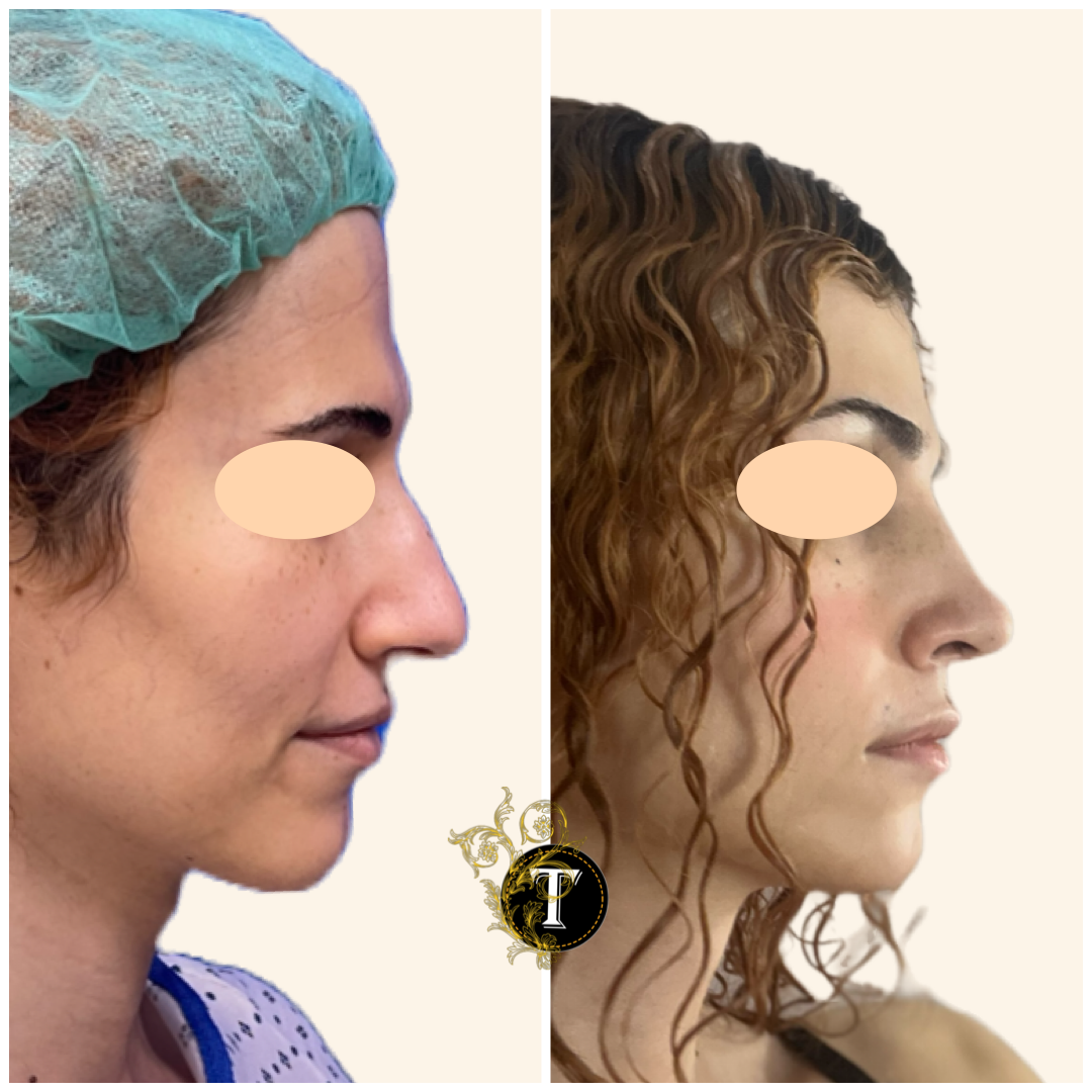 Before and After Image: Rhinoplasty - right-side