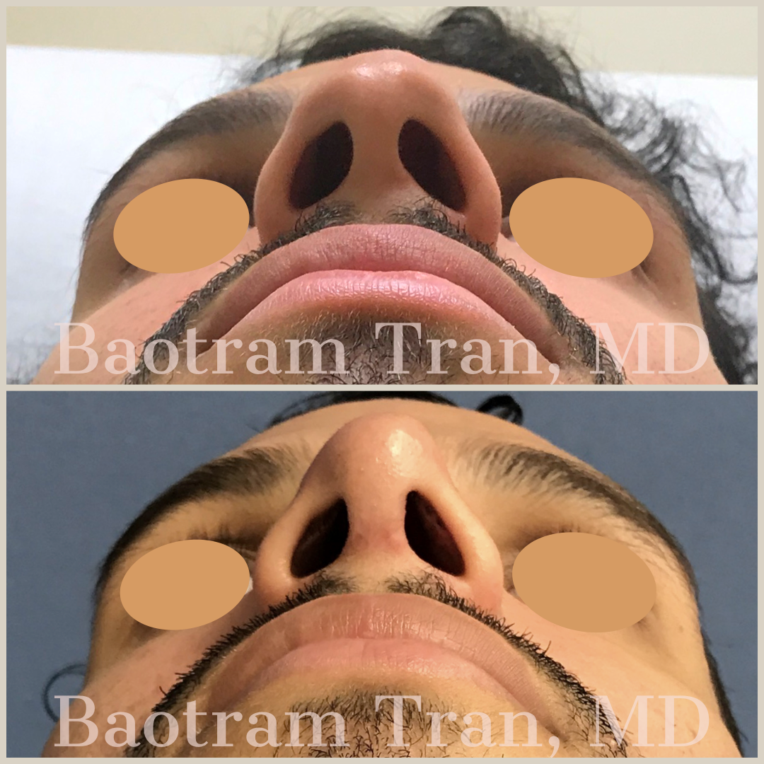Before and After Image: Rhinoplasty - front