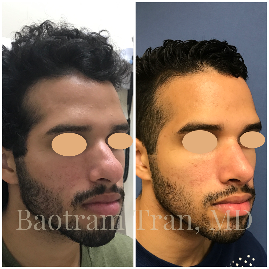 Before and After Image: Rhinoplasty - right-front-oblique