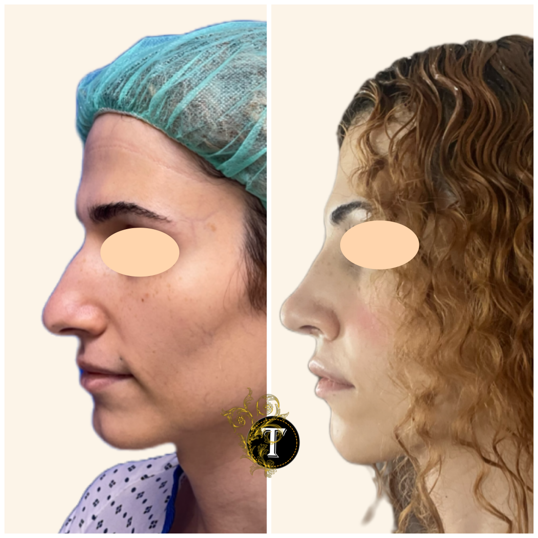 Before and After Image: Rhinoplasty - left-side