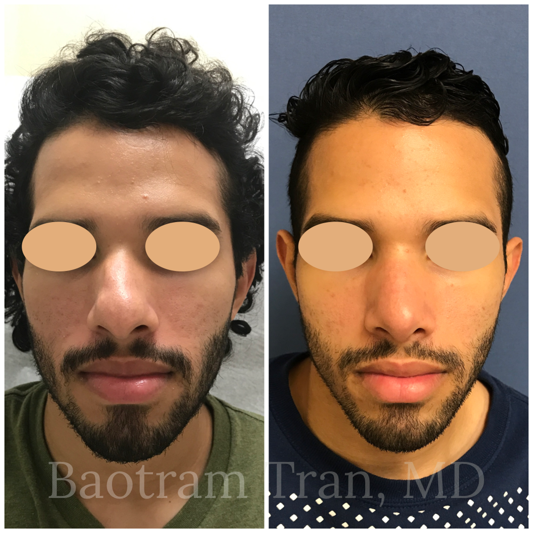 Before and After Image: Rhinoplasty