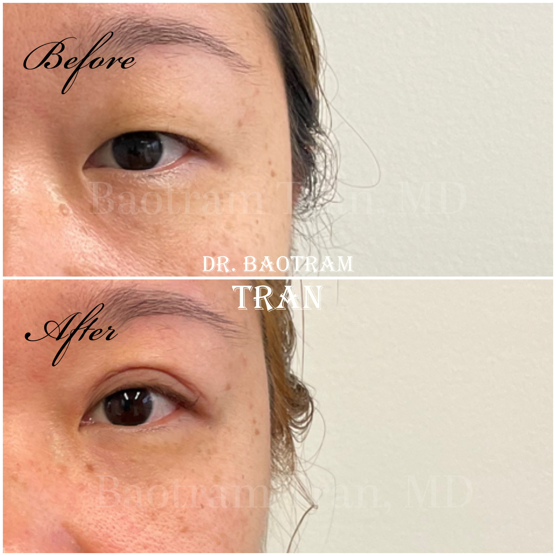 Before and After Image: Asian eyelid surgery - front