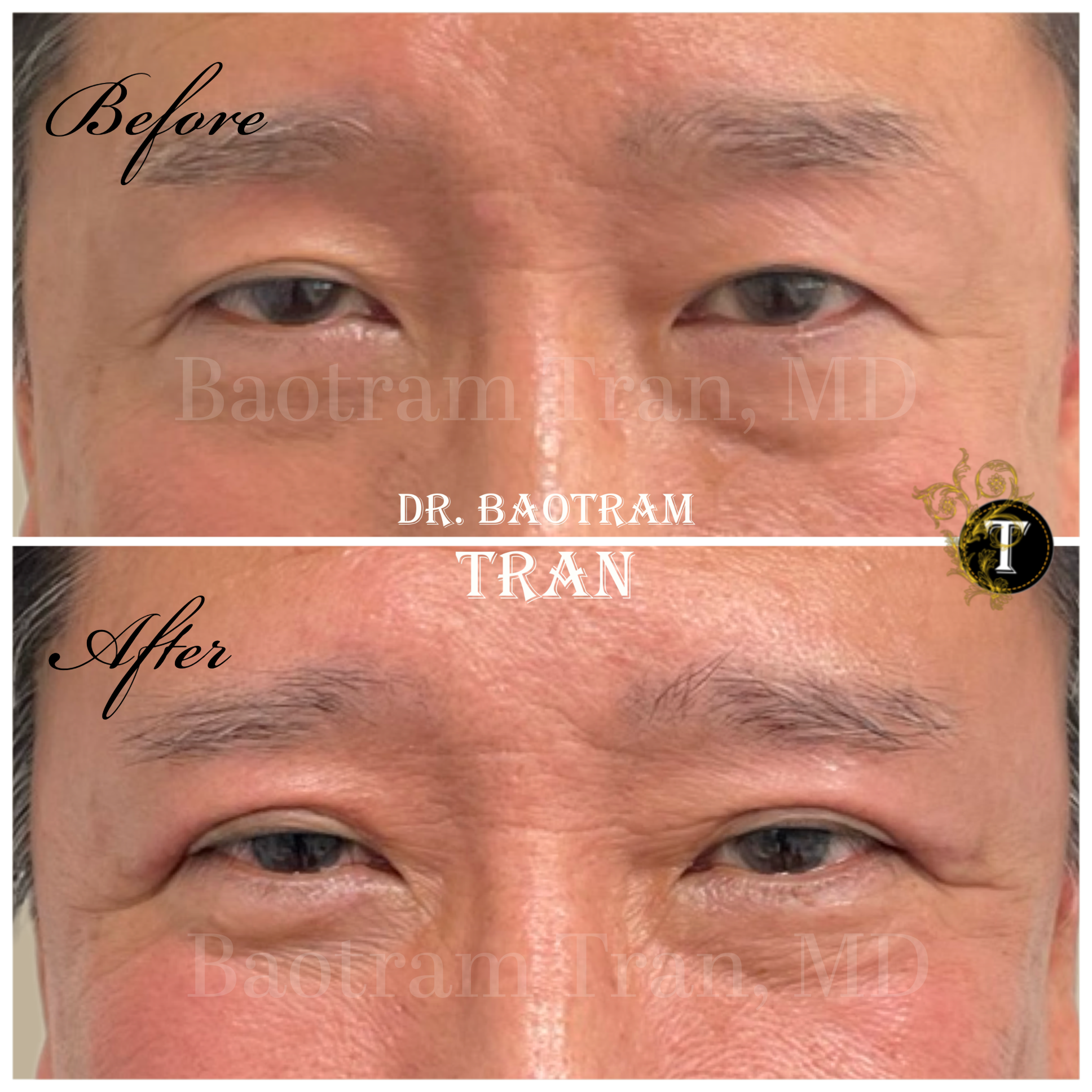Before and After Image: Asian Eyelid Surgery - front