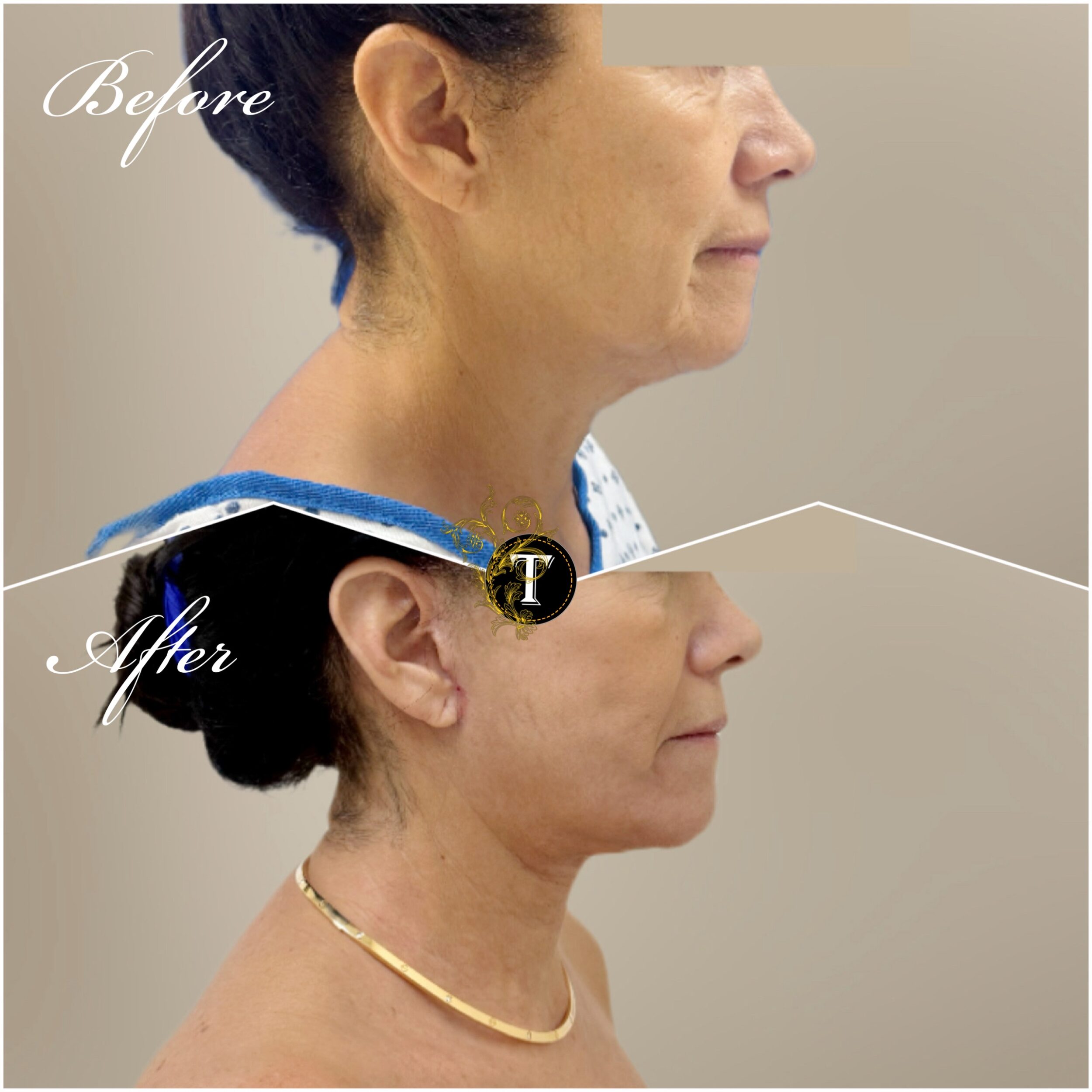 Before and After Image: Facelift and Neck Lift - right-side