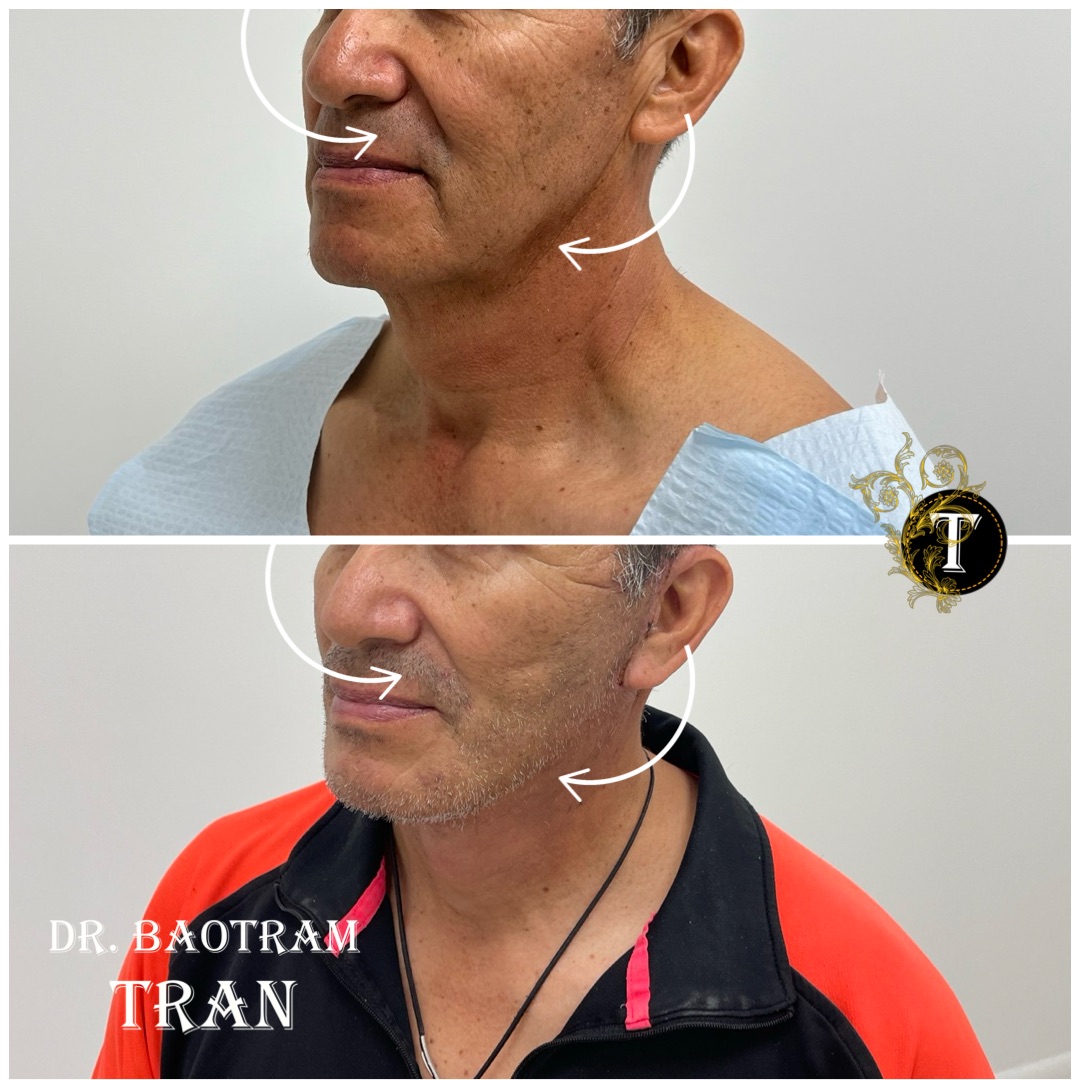 Before and After Image: Facelift & Neck Lift - left-front-oblique