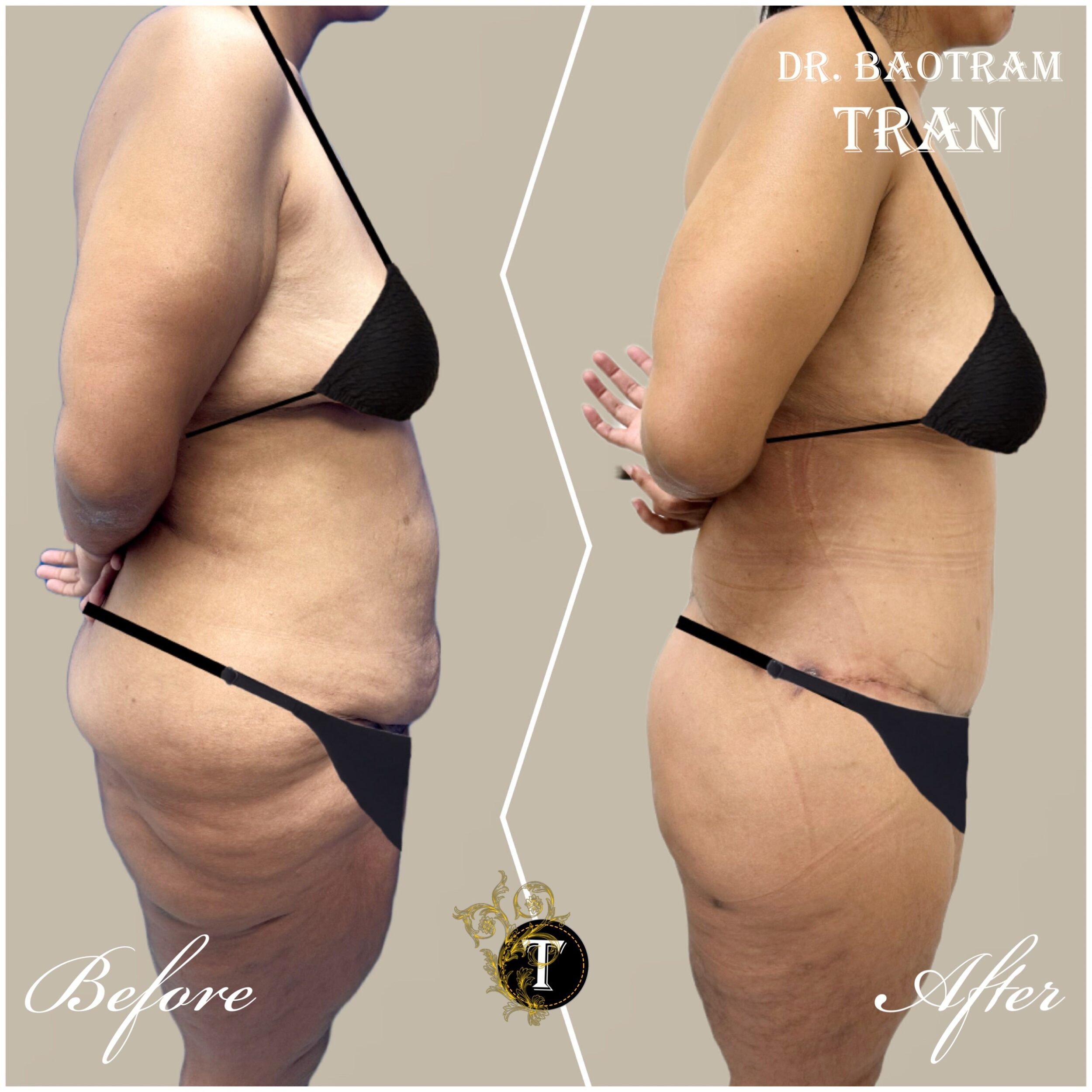 Before and After Image: Tummy Tuck - right-side