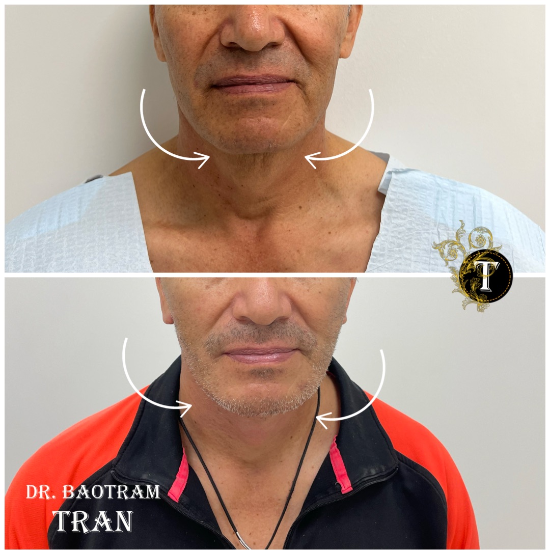Before and After Image: Facelift & Neck Lift - front