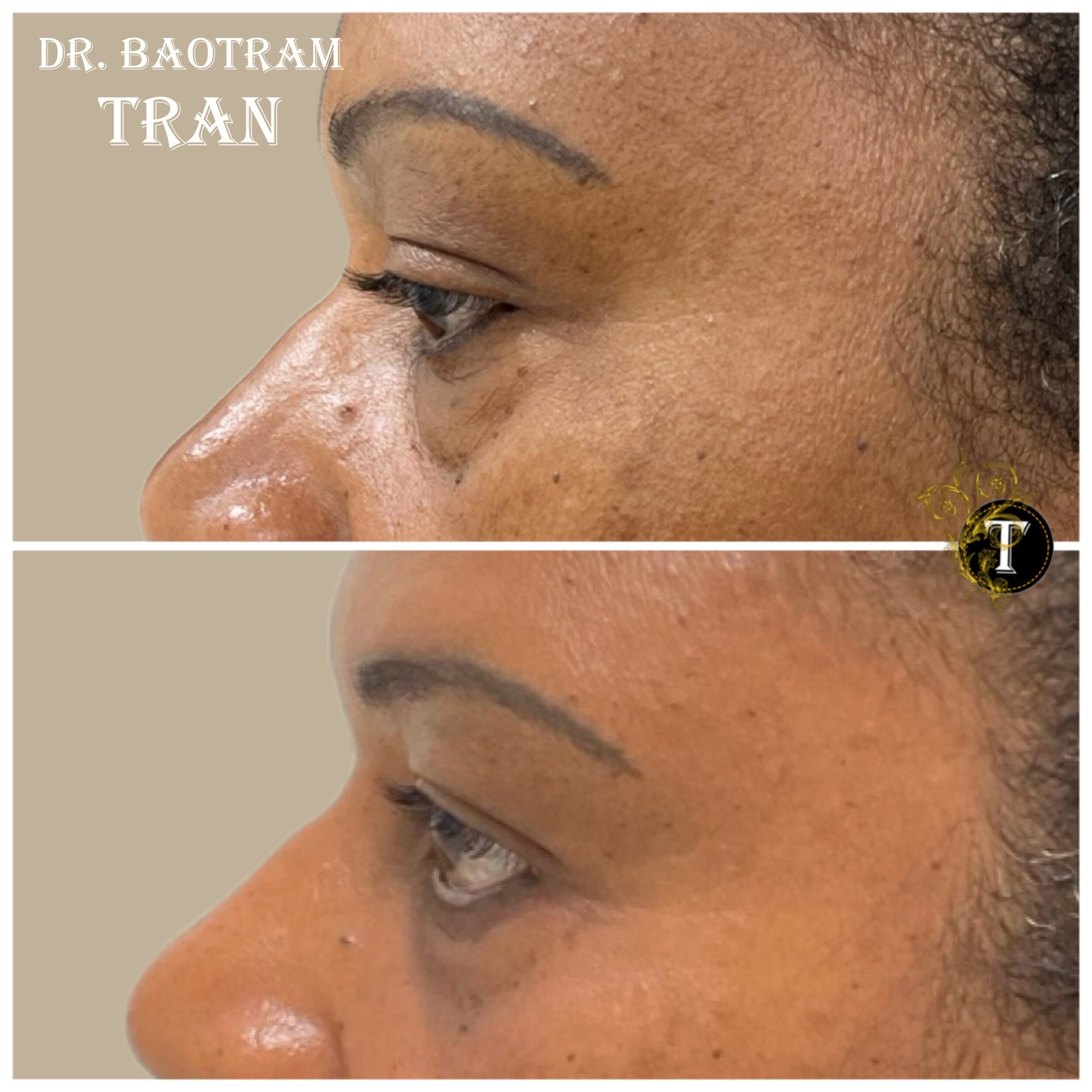 Before and After Image: Lower Eyelid Surgery -