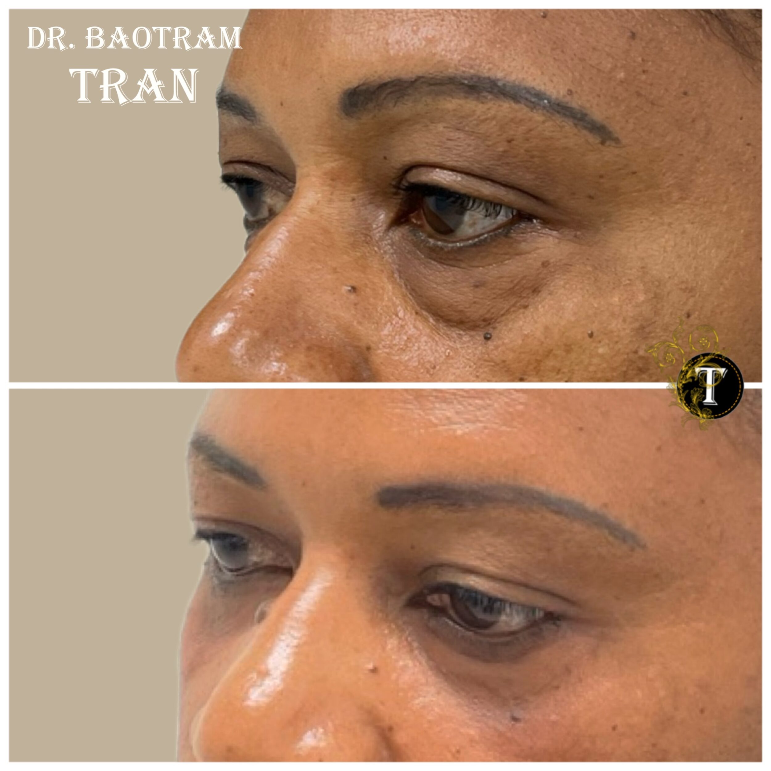 Before and After Image: Lower Eyelid Surgery