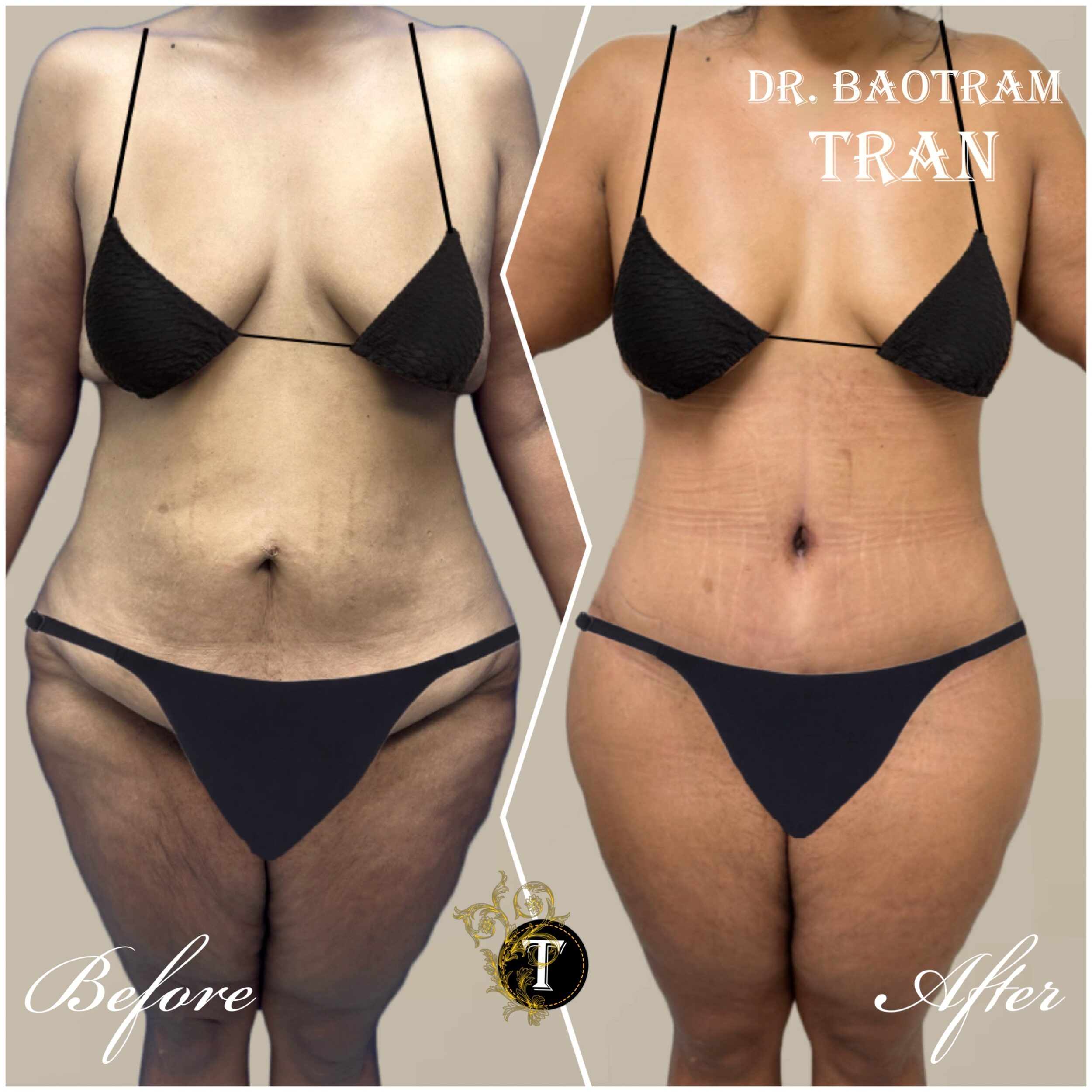 Before and After Image: Tummy Tuck