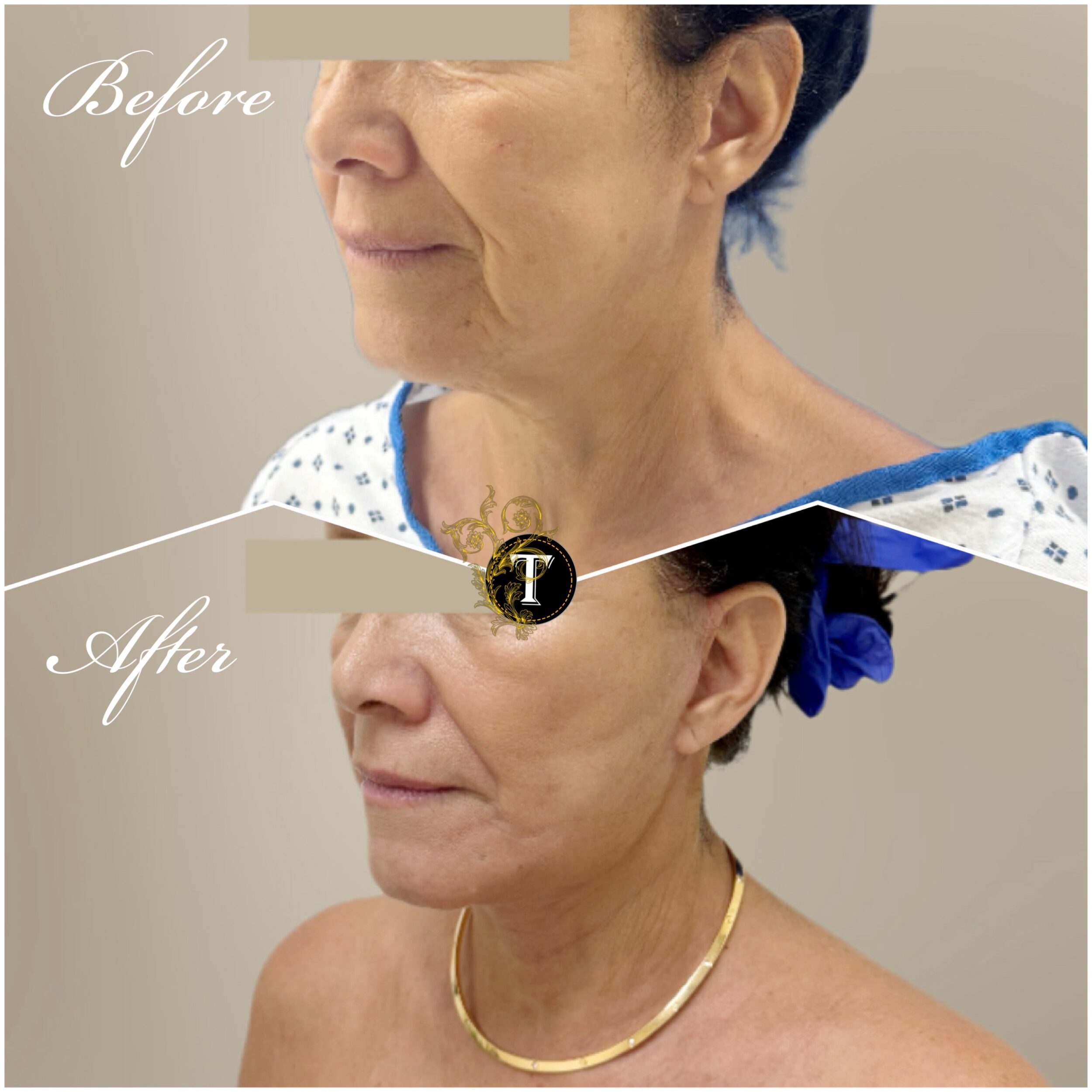 Before and After Image: Facelift and Neck Lift - left-front-oblique