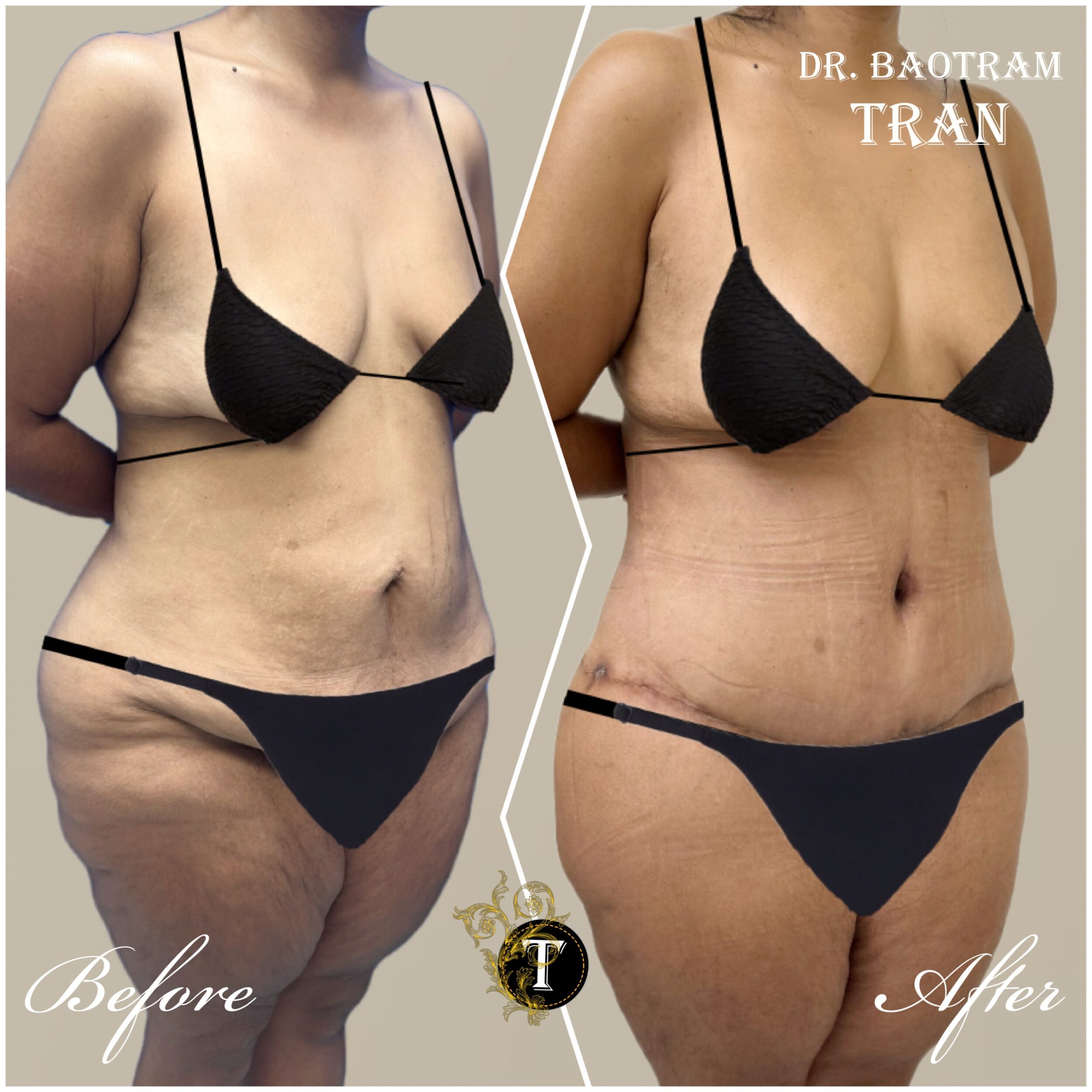 Before and After Image: Tummy Tuck -