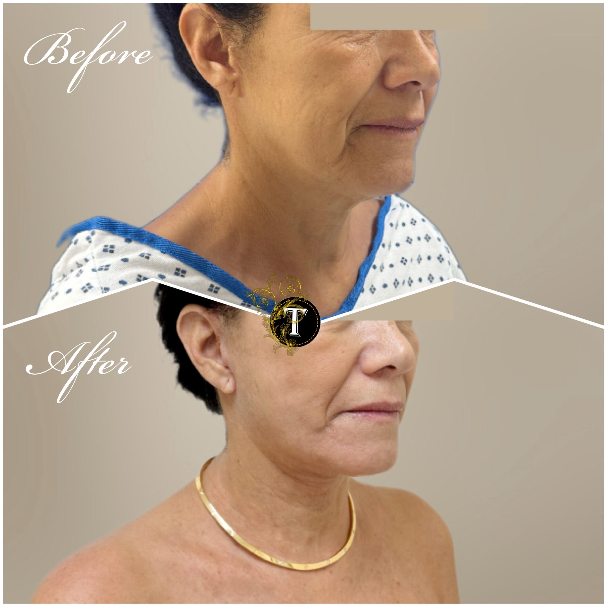Before and After Image: Facelift and Neck Lift - right-front-oblique