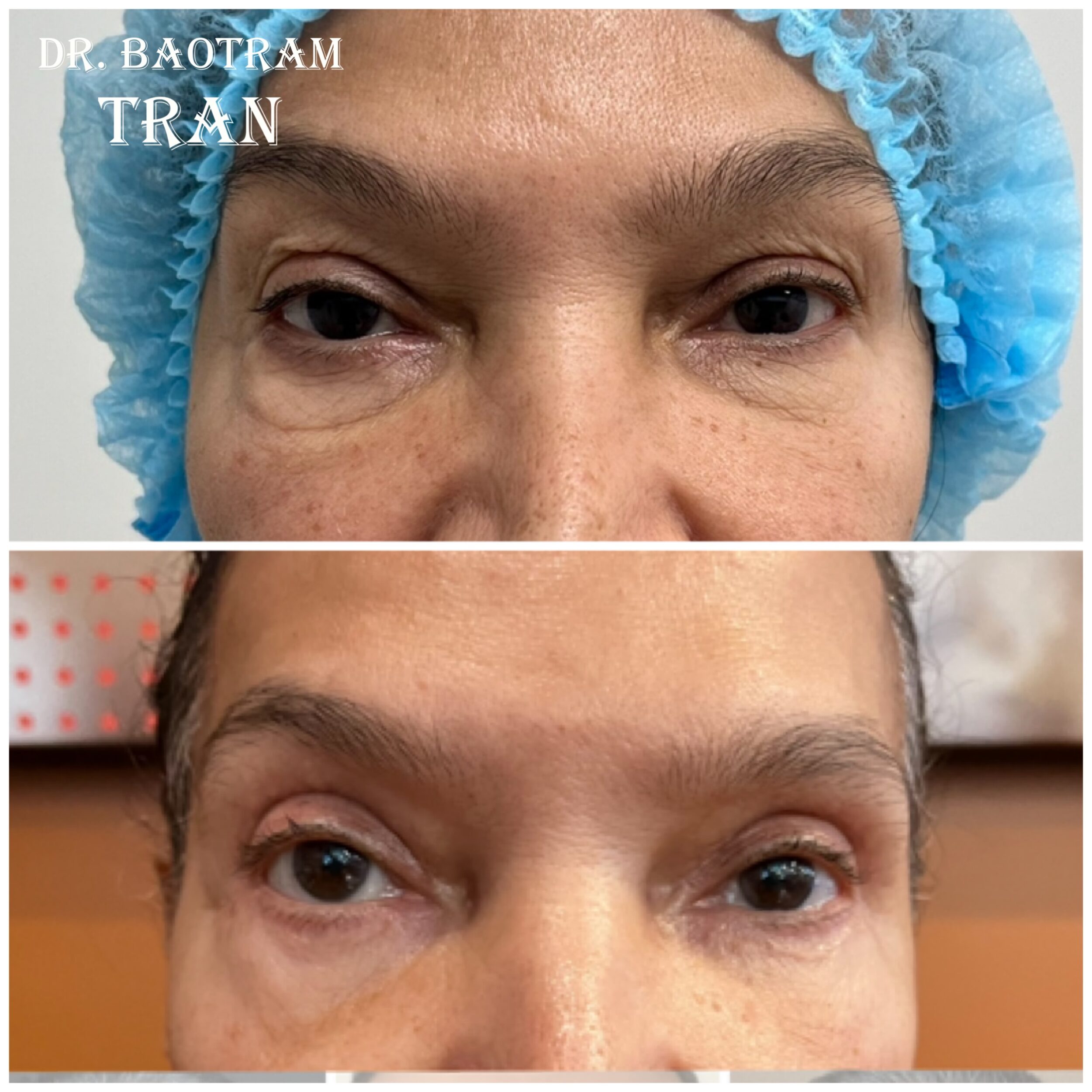 Before and After Image: Upper and Lower Eyelid Surgery - front