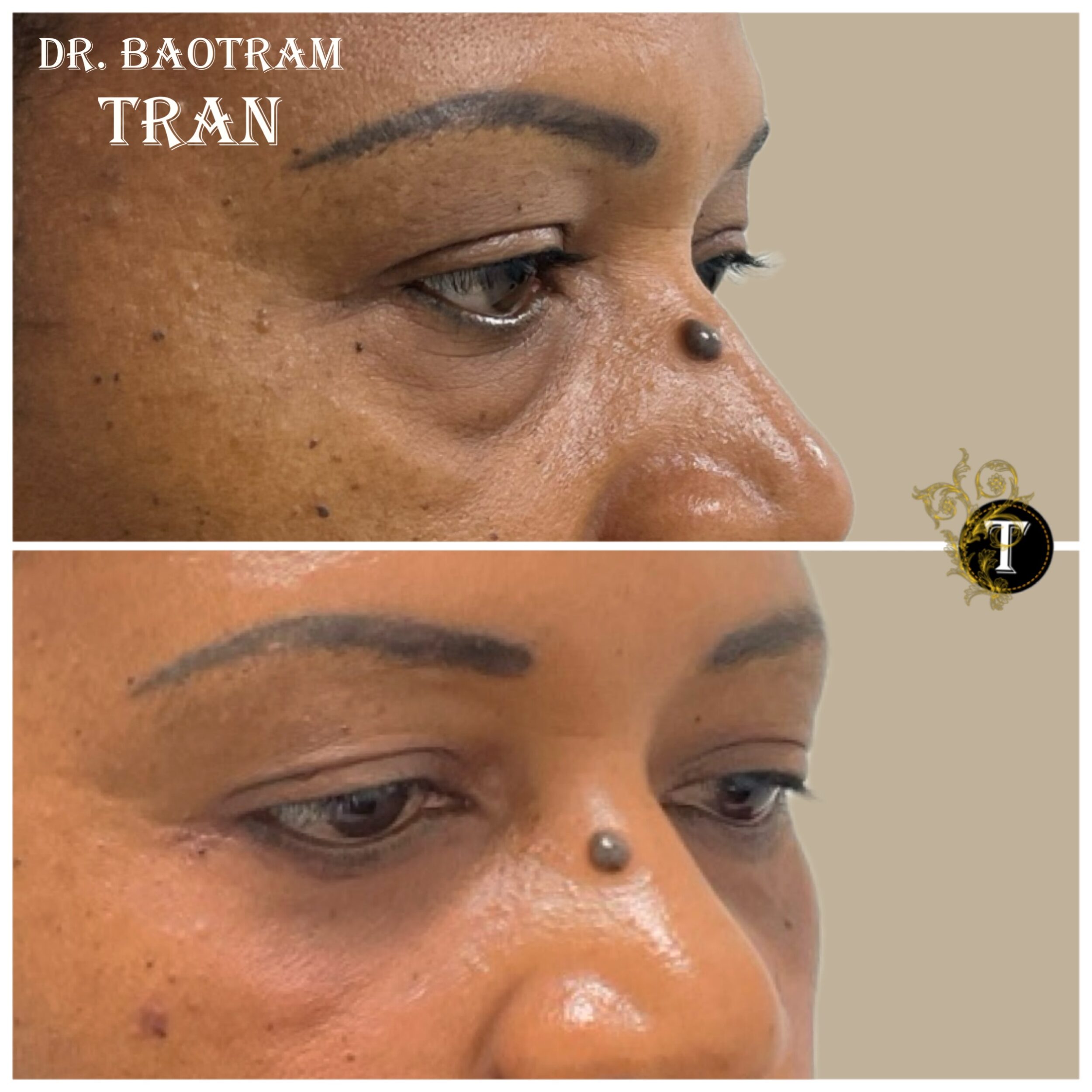 Before and After Image: Lower Eyelid Surgery -