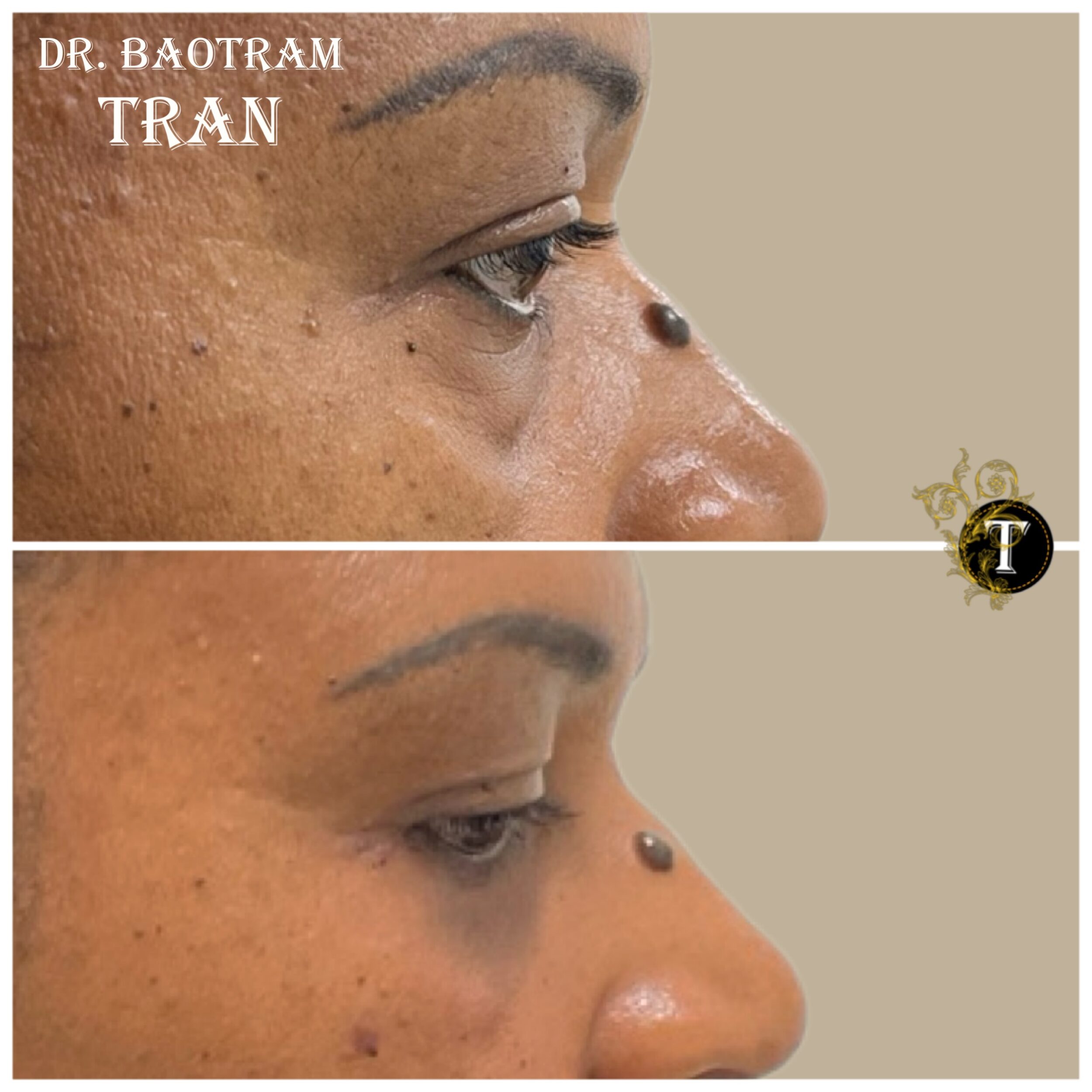 Before and After Image: Lower Eyelid Surgery -