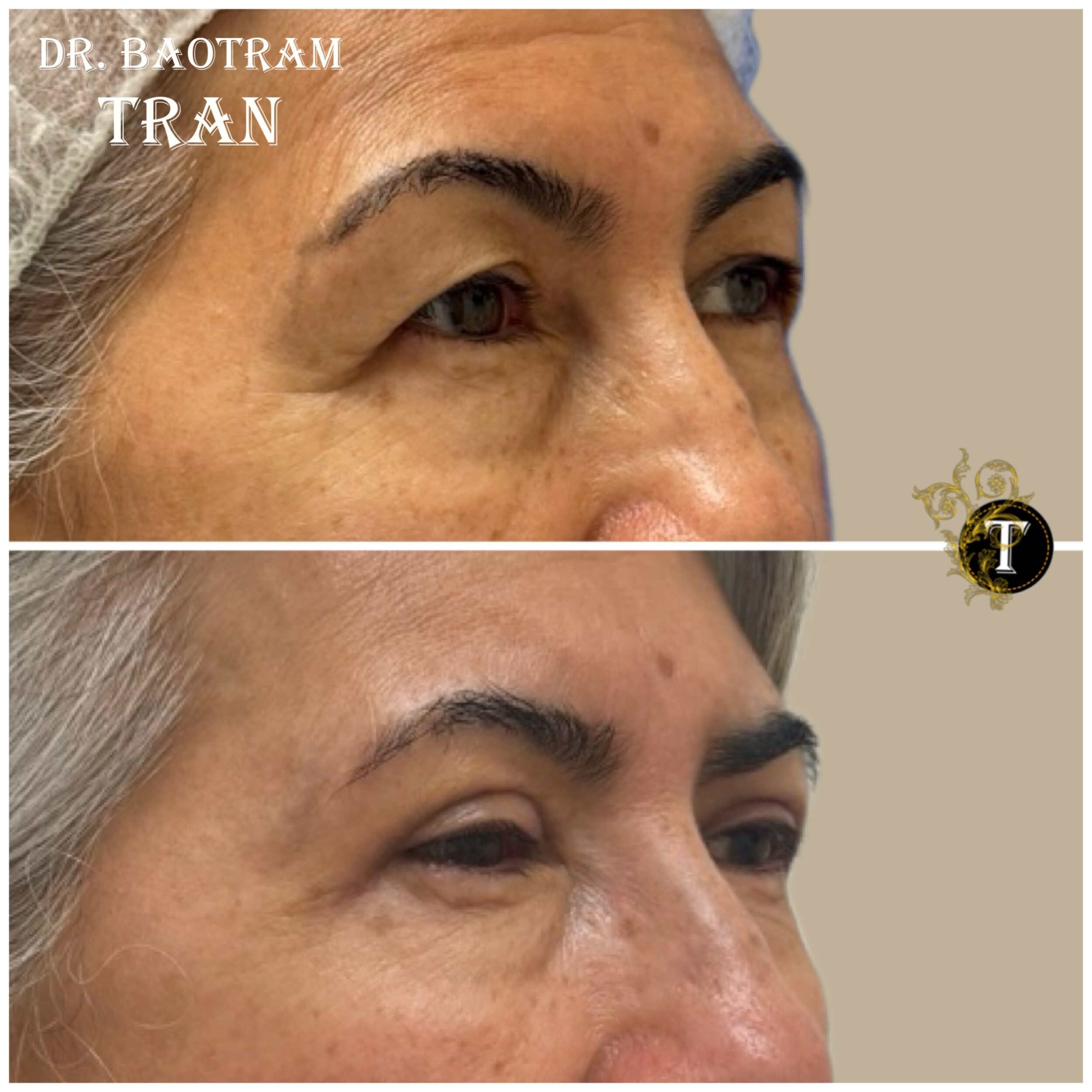 Before and After Image: Upper Eyelid Surgery - right-front-oblique