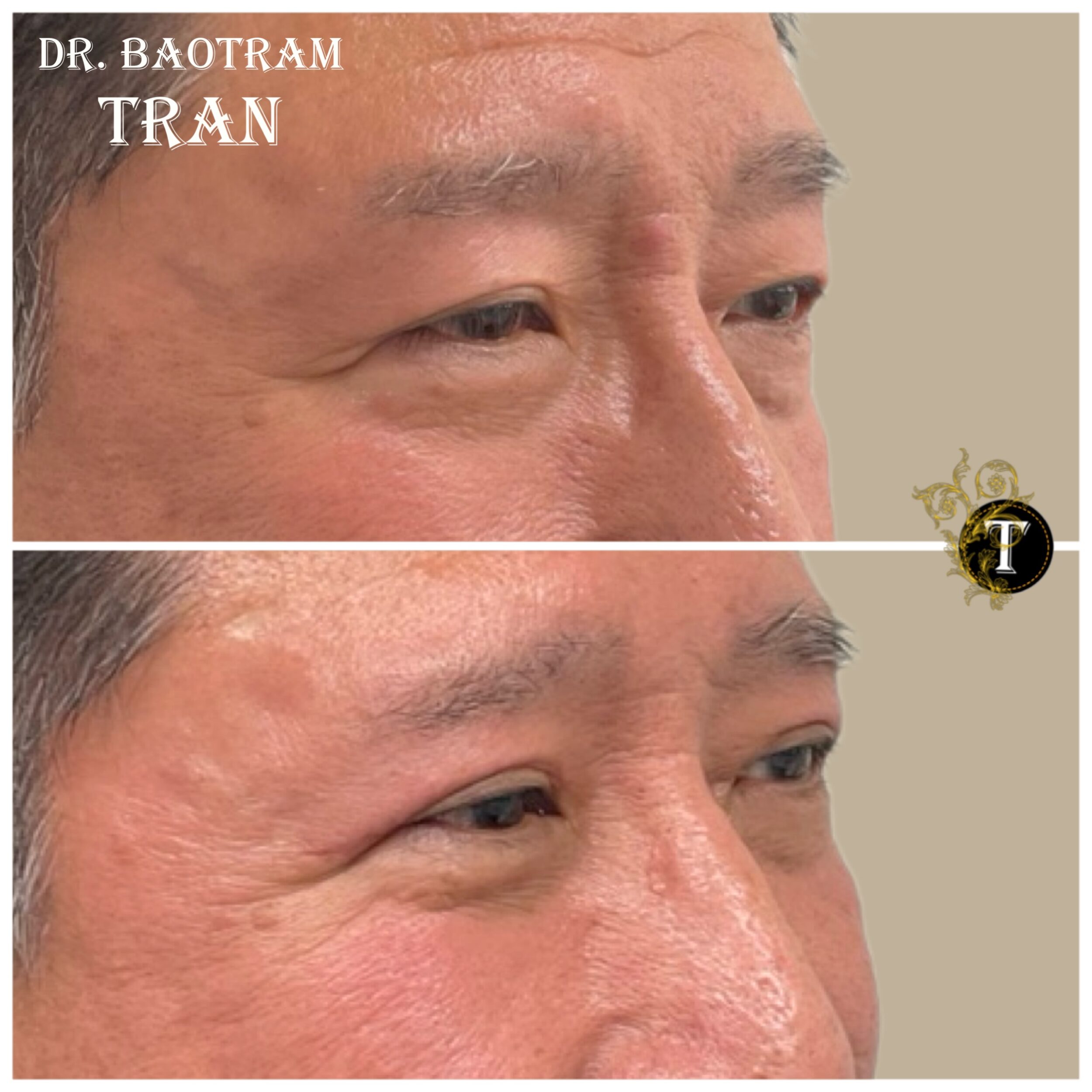 Before and After Image: Upper Eyelid Surgery - right-front-oblique