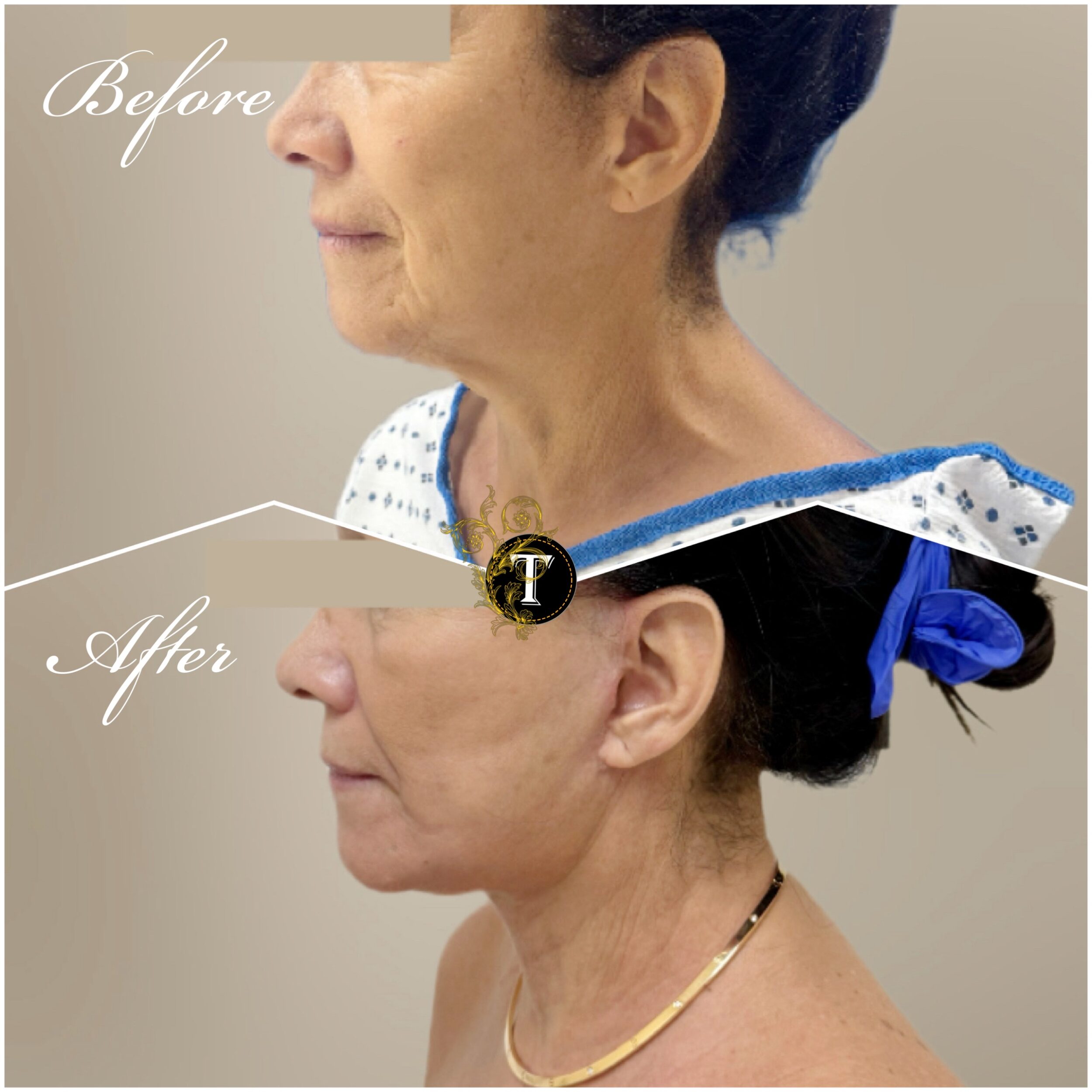 Before and After Image: Facelift and Neck Lift - left-side