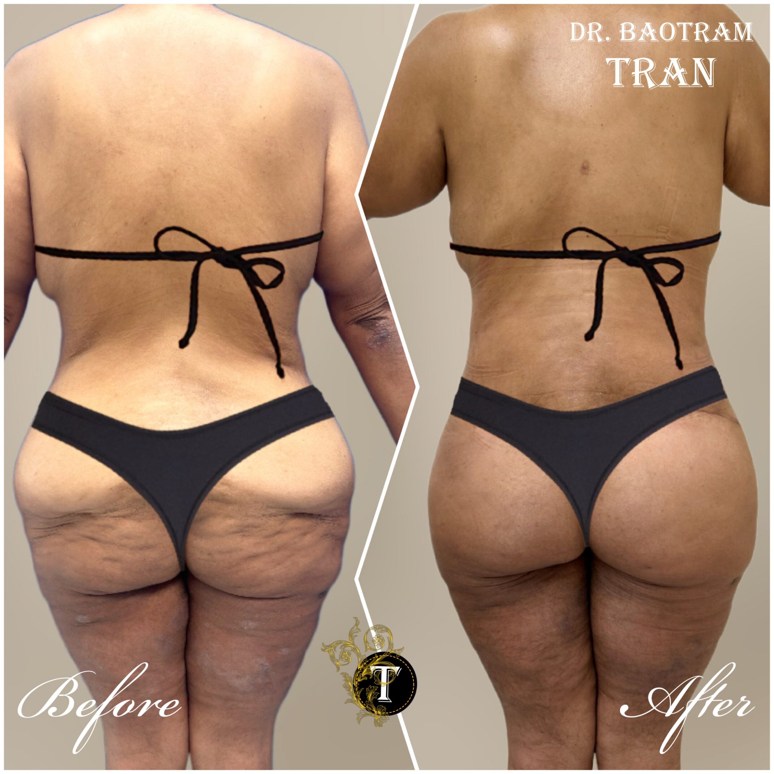 Before and After Image: Tummy Tuck - back