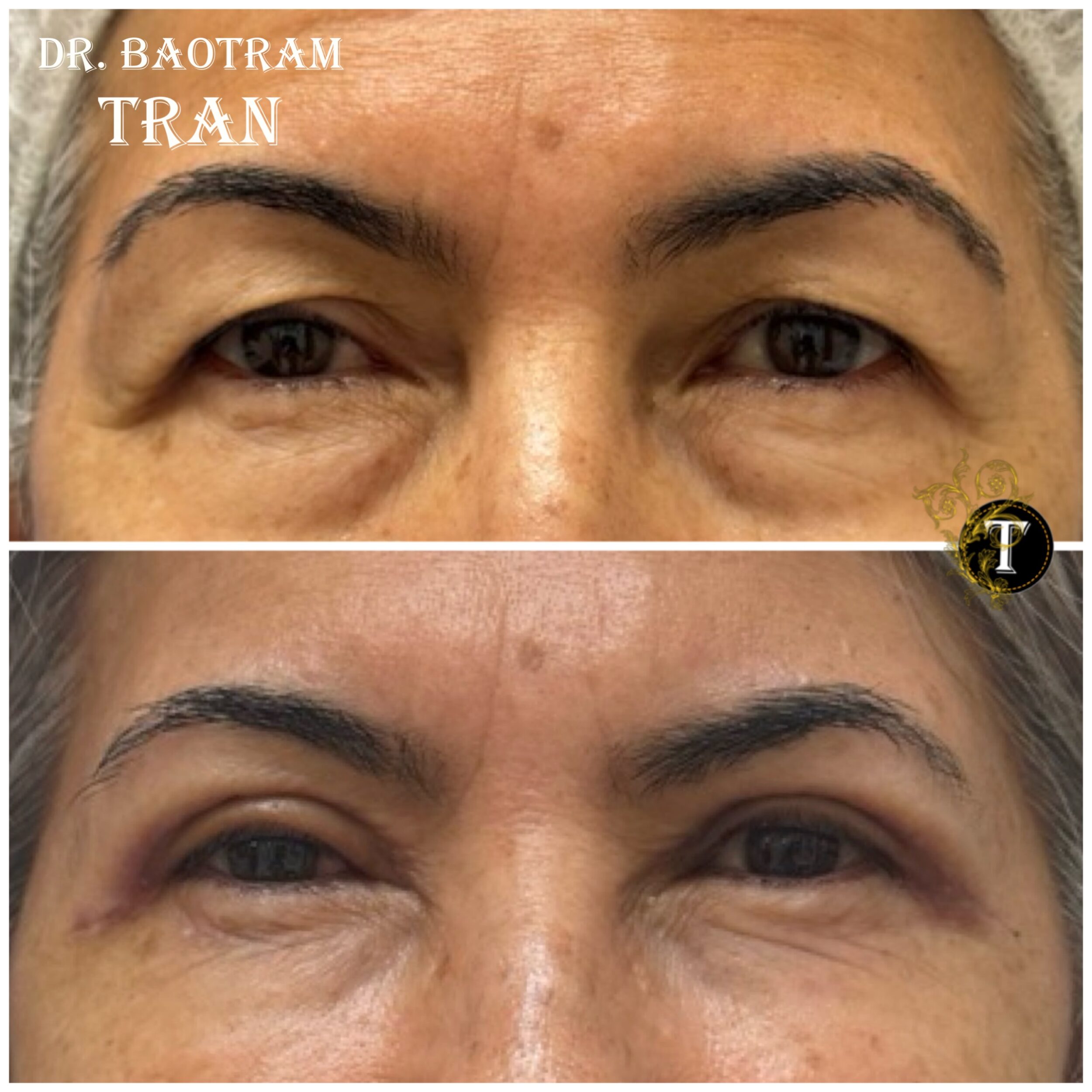Before and After Image: Upper Eyelid Surgery