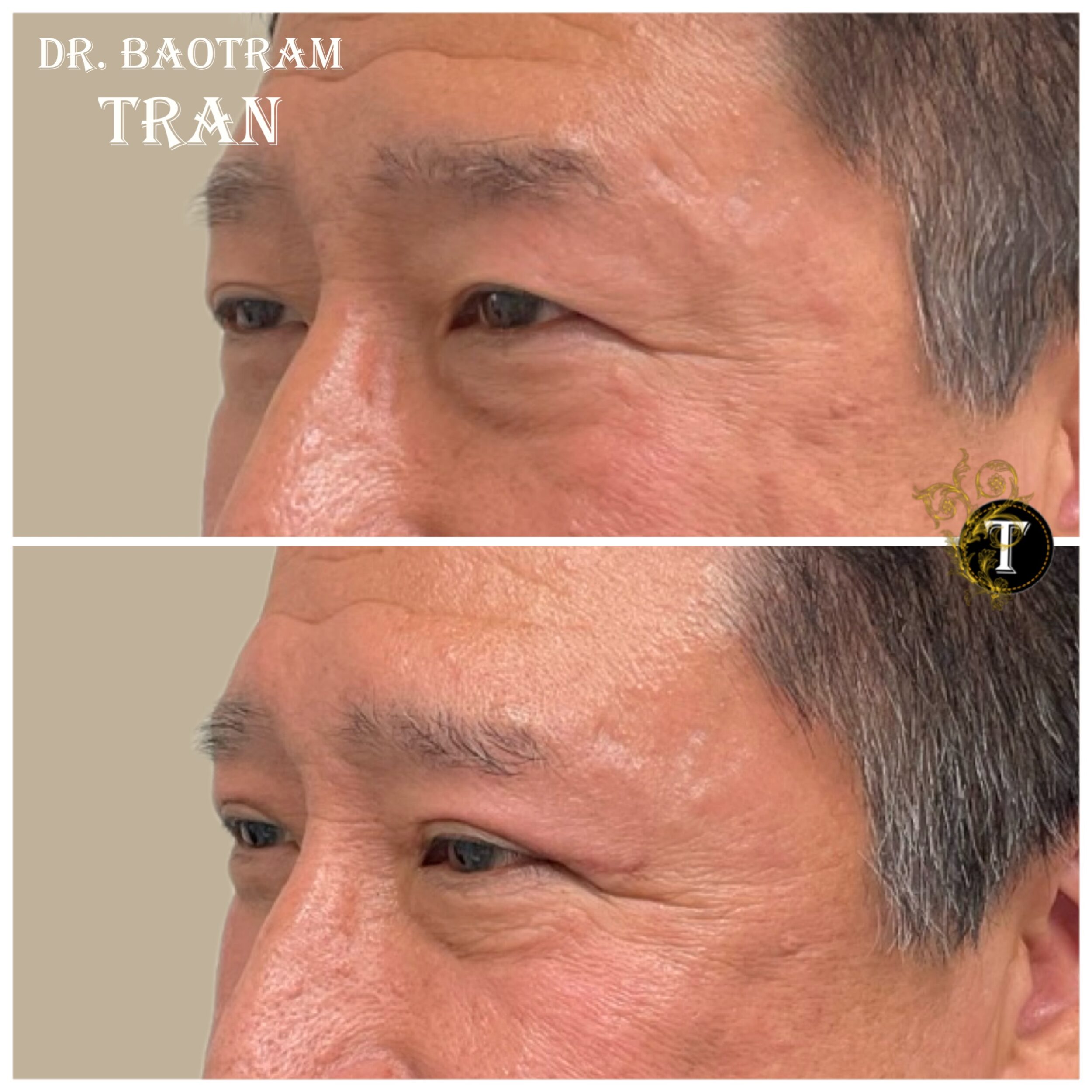 Before and After Image: Upper Eyelid Surgery - left-front-oblique