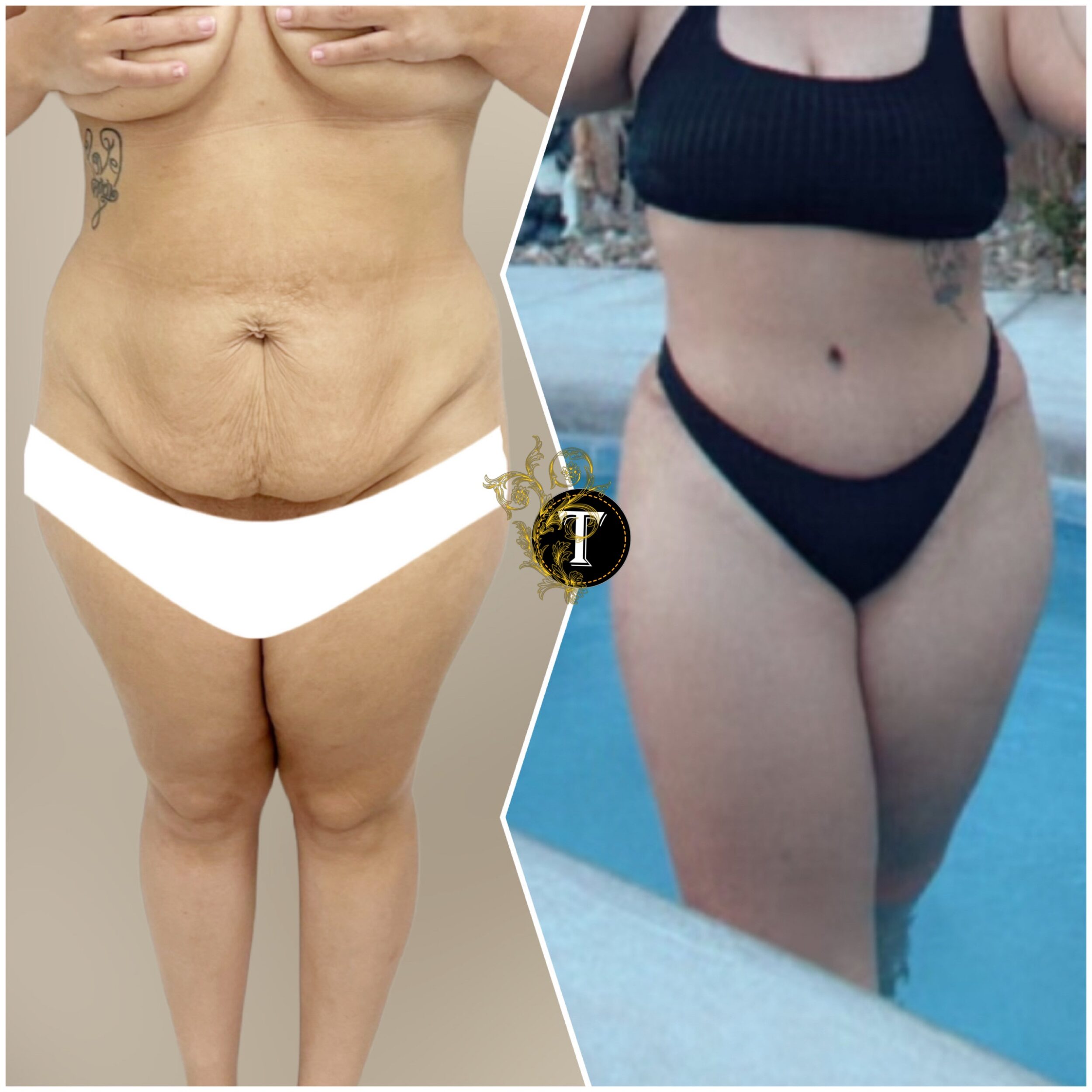 Before and After Image: Tummy Tuck
