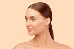 Side profile of a middle-aged woman with arrows showing how her facelift helped improve facial contours.