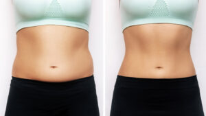 Before and after image of a woman's stomach after having liposuction to remove stubborn belly fat.