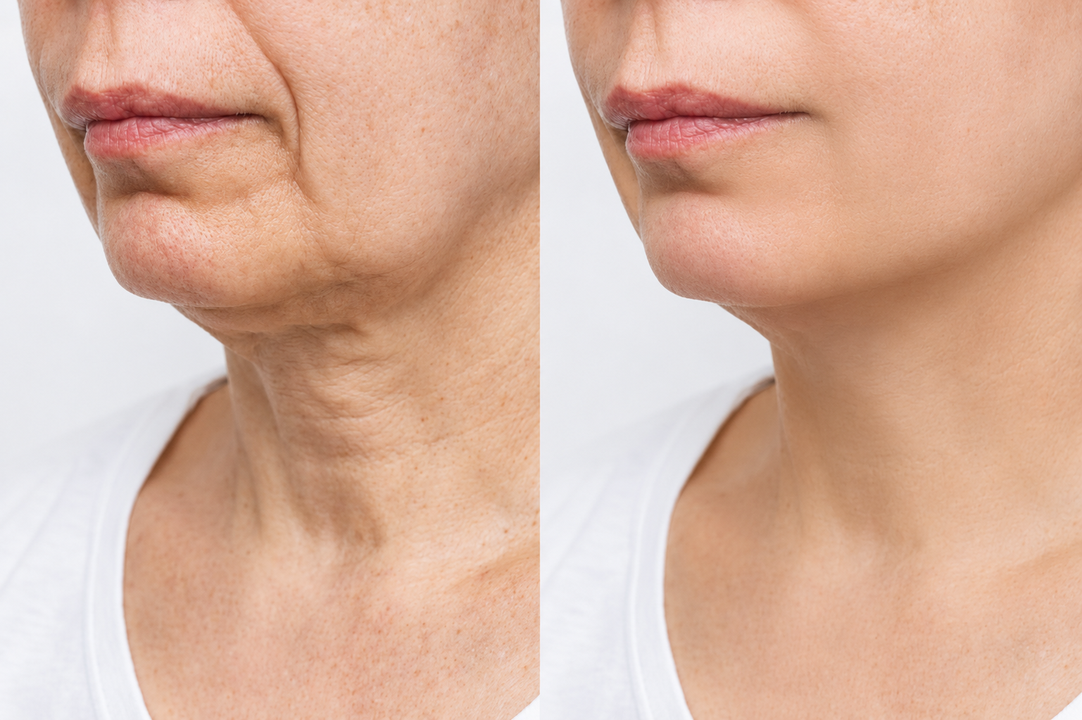 Before and after of an older woman getting a neck lift for a slimmer, more defined jawline.