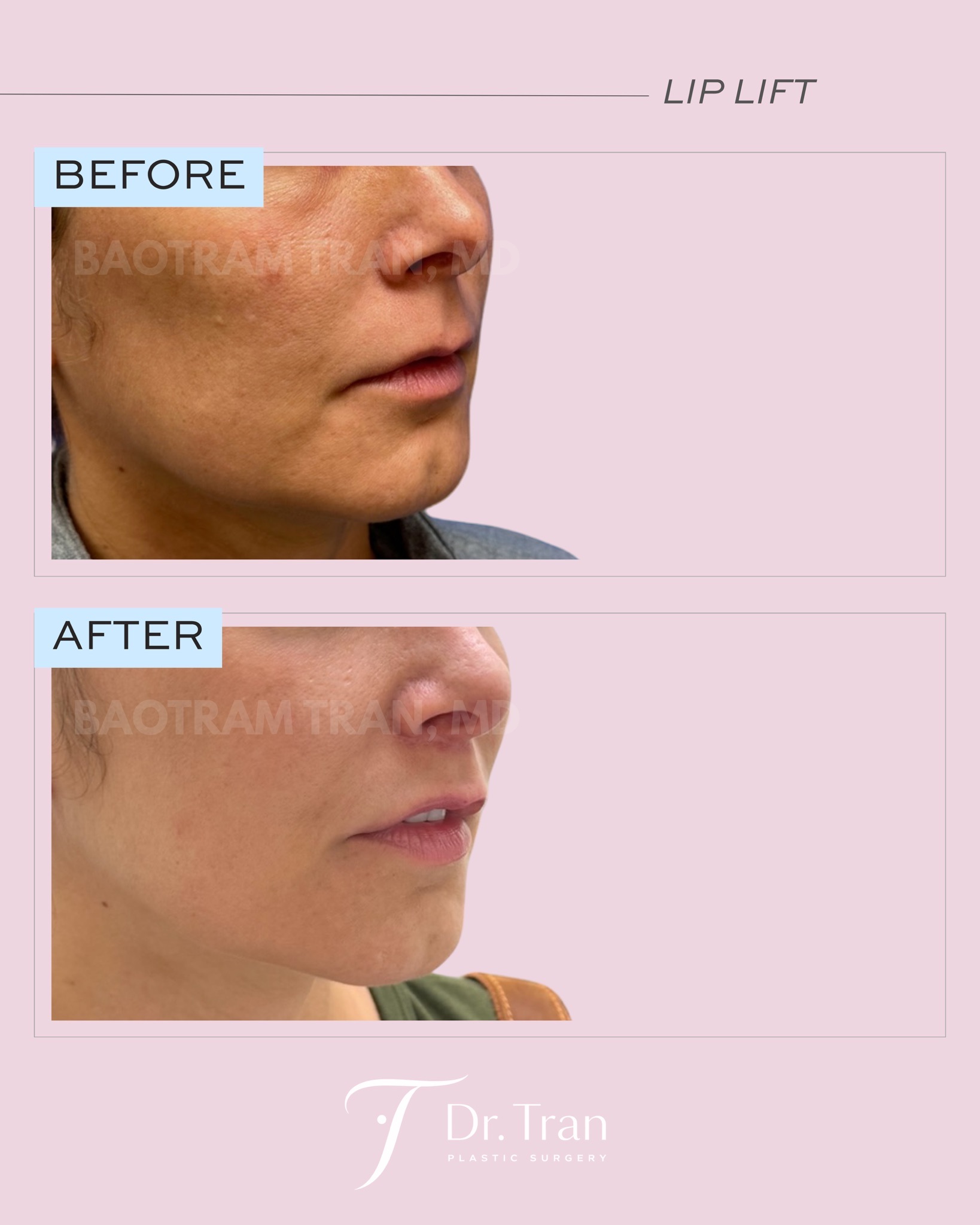Before and After Image: Lip Lift - right-front-oblique